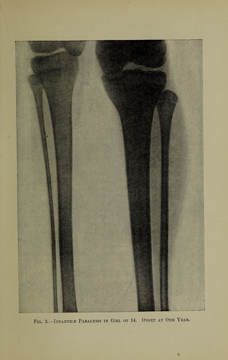 Fig. 3.—Infantile Paralysis in Girl of 14. Onset at One Year,