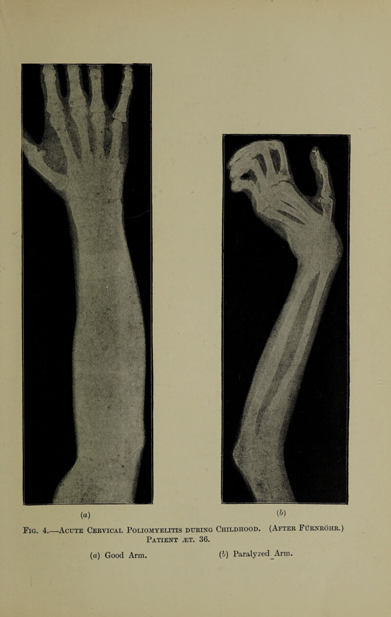 (a) (&) Fig. 4.—Acute Cervical Poliomyelitis during Childhood. (After Fürnröhr.) Patient jet. 36. (a) Good Arm (b) Paralyzed^ Arm