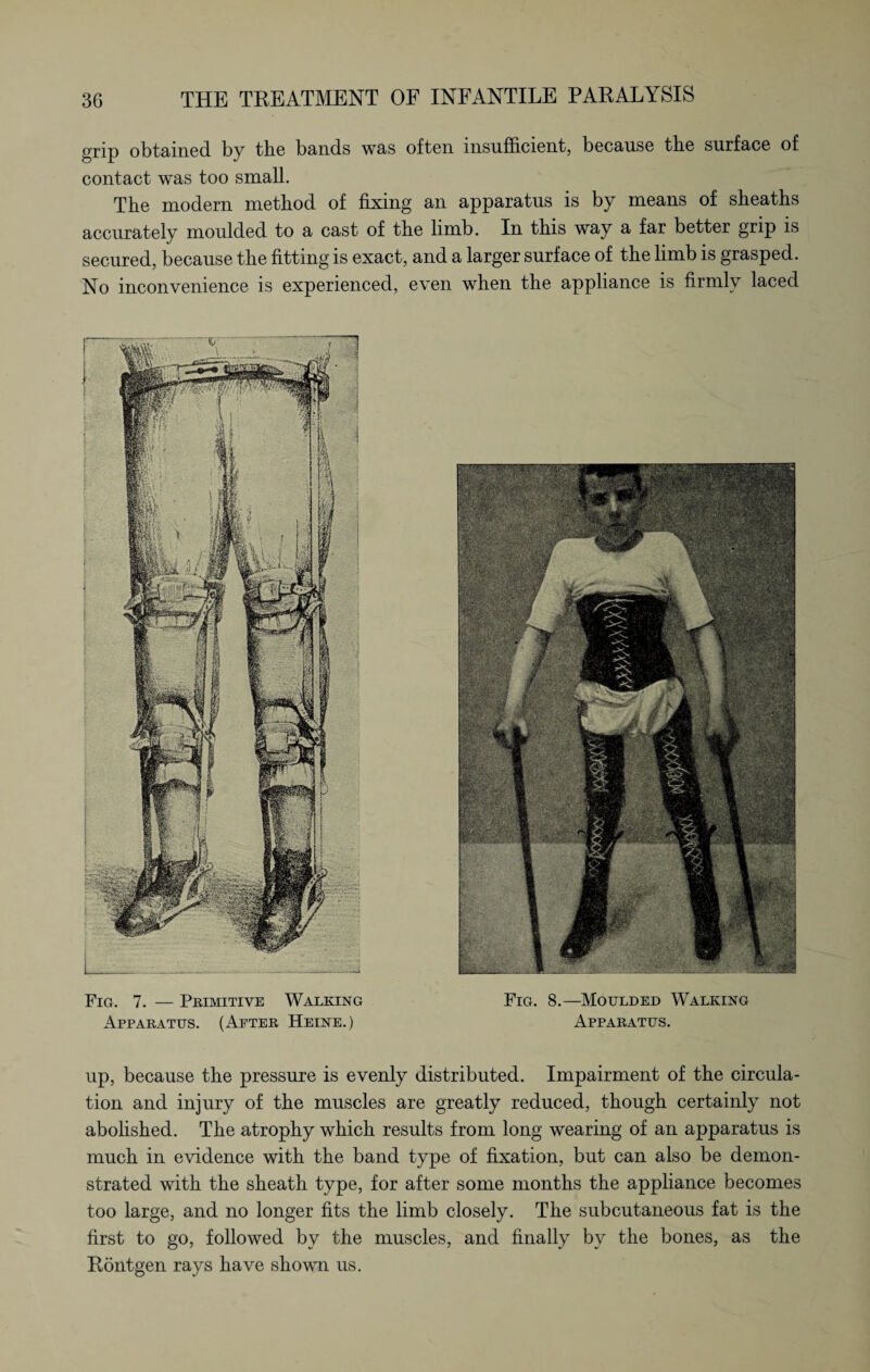 grip obtained by the bands was often insufficient, because the surface of contact was too small. The modern method of fixing an apparatus is by means of sheaths accurately moulded to a cast of the limb. In this way a far better grip is secured, because the fitting is exact, and a larger surface of the limb is grasped. No inconvenience is experienced, even when the appliance is firmly laced Fig. 7. — Primitive Walking Fig. 8.—Moulded Walking Apparatus. (After Heine.) Apparatus. up, because the pressure is evenly distributed. Impairment of the circula¬ tion and injury of the muscles are greatly reduced, though certainly not abolished. The atrophy which results from long wearing of an apparatus is much in evidence with the band type of fixation, but can also be demon¬ strated with the sheath type, for after some months the appliance becomes too large, and no longer fits the limb closely. The subcutaneous fat is the first to go, followed by the muscles, and finally by the bones, as the Röntgen rays have shown us.