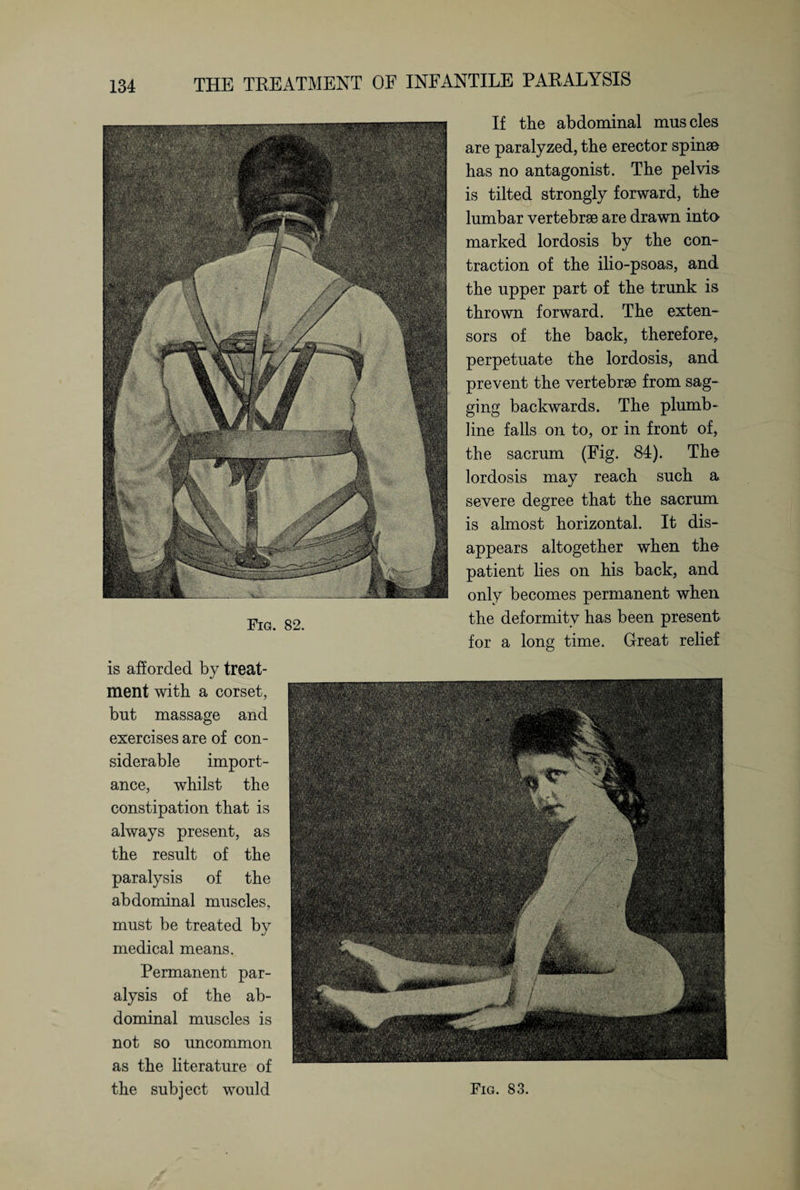 Fig. 82. If the abdominal muscles are paralyzed, the erector spinae has no antagonist. The pelvis is tilted strongly forward, the lumbar vertebrae are drawn into marked lordosis by the con¬ traction of the ilio-psoas, and the upper part of the trunk is thrown forward. The exten¬ sors of the back, therefore,, perpetuate the lordosis, and prevent the vertebrae from sag¬ ging backwards. The plumb- line falls on to, or in front of, the sacrum (Fig. 84). The lordosis may reach such a severe degree that the sacrum is almost horizontal. It dis¬ appears altogether when the patient lies on his back, and only becomes permanent when the deformity has been present for a long time. Great relief is afforded by treat¬ ment with a corset, but massage and exercises are of con¬ siderable import¬ ance, whilst the constipation that is always present, as the result of the paralysis of the abdominal muscles, must be treated by medical means. Permanent par¬ alysis of the ab¬ dominal muscles is not so uncommon as the literature of the subject would Fig. 83.