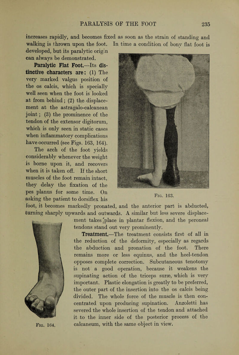 increases rapidly, and becomes fixed as soon as the strain of standing and walking is thrown upon the foot. In time a condition of bonv flat foot is developed, but its paralytic origin can always be demonstrated. Paralytic Flat Foot.—Its dis¬ tinctive characters are: (1) The very marked valgus position of the os calcis, which is specially well seen when the foot is looked at from behind; (2) the displace¬ ment at the astragalo-calcanean joint; (3) the prominence of the tendon of the extensor digitorum, which is only seen in static cases when inflammatory complications have occurred (see Figs. 163, 161). The arch of the foot yields considerably whenever the weight is borne upon it, and recovers when it is taken off. If the short muscles of the foot remain intact, they delay the fixation of the pes planus for some time. On asking the patient to dorsiflex his foot, it becomes markedly pronated, and the anterior part is abducted, turning sharply upwards and outwards. A similar but less severe displace¬ ment takes '’place in plantar flexion, and the peroneal tendons stand out very prominently. Treatment.—The treatment consists first of all in the reduction of the deformity, especially as regards the abduction and pronation of the foot. There remains more or less equinus, and the heel-tendon opposes complete correction. Subcutaneous tenotomy is not a good operation, because it weakens the supinating action of the triceps surae, which is very important. Plastic elongation is greatly to be preferred, the outer part of the insertion into the os calcis being divided. The whole force of the muscle is then con¬ centrated upon producing supination. Anzoletti has severed the whole insertion of the tendon and attached it to the inner side of the posterior process of the