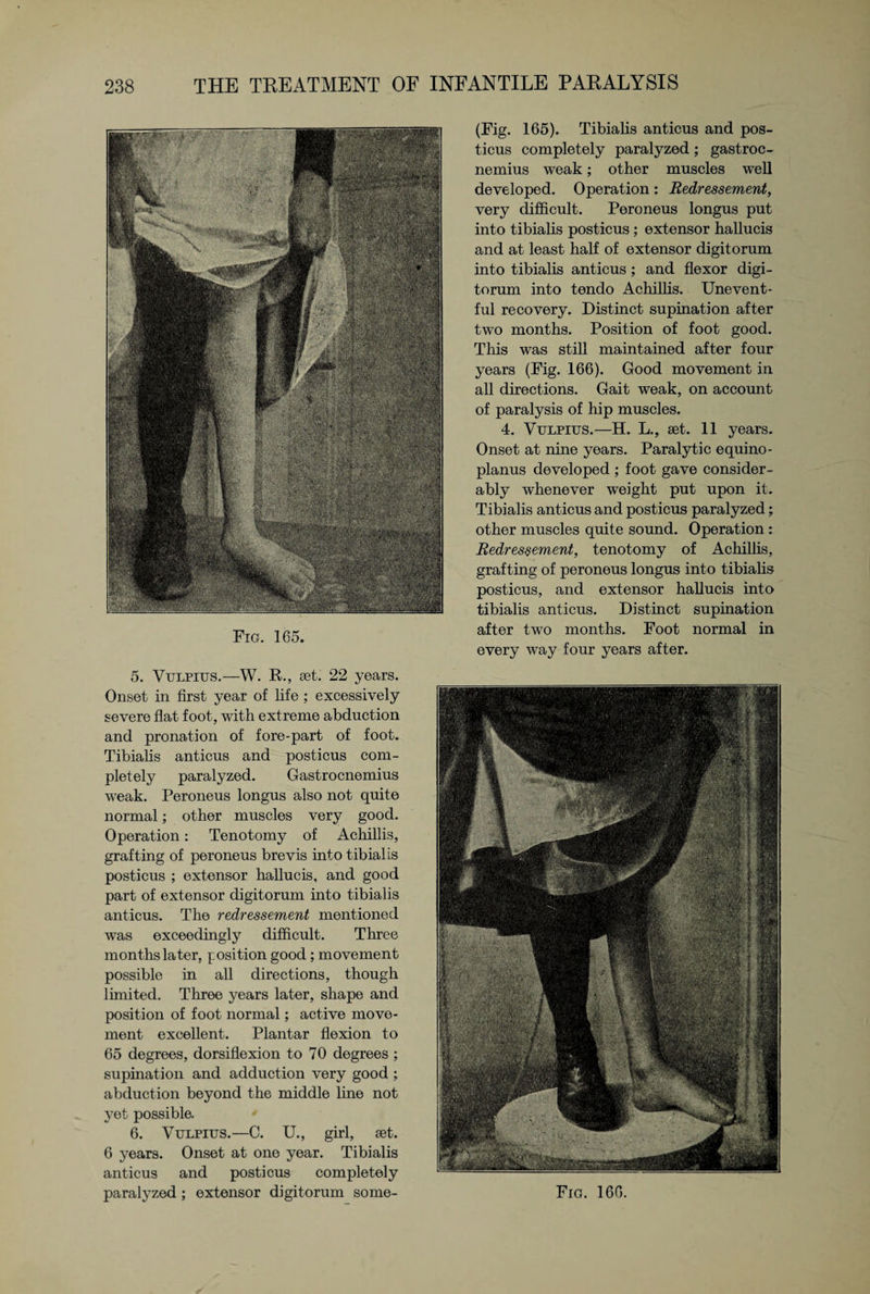 Fig. 165. 5. Vulpius.—W. R., set. 22 years. Onset in first year of life ; excessively severe flat foot, with extreme abduction and pronation of fore-part of foot. Tibialis anticus and posticus com¬ pletely paralyzed. Gastrocnemius weak. Peroneus longus also not quite normal; other muscles very good. Operation: Tenotomy of Achillis, grafting of peroneus brevis into tibialis posticus ; extensor hallucis, and good part of extensor digitorum into tibialis anticus. The redressement mentioned was exceedingly difficult. Three months later, position good ; movement possible in all directions, though limited. Three years later, shape and position of foot normal; active move¬ ment excellent. Plantar flexion to 65 degrees, dorsiflexion to 70 degrees ; supination and adduction very good ; abduction beyond the middle line not yet possible, 6. Vulpius.—C. U., girl, set. 6 years. Onset at one year. Tibialis anticus and posticus completely (Fig. 165). Tibialis anticus and pos¬ ticus completely paralyzed; gastroc¬ nemius weak; other muscles well developed. Operation: Redressement, very difficult. Peroneus longus put into tibialis posticus ; extensor hallucis and at least half of extensor digitorum into tibialis anticus ; and flexor digi¬ torum into tendo Achillis. Unevent¬ ful recovery. Distinct supination after two months. Position of foot good. This was still maintained after four years (Fig. 166). Good movement in all directions. Gait weak, on account of paralysis of hip muscles. 4. Vulpius.—H. L., set. 11 years. Onset at nine years. Paralytic equino- planus developed ; foot gave consider¬ ably whenever weight put upon it. Tibialis anticus and posticus paralyzed; other muscles quite sound. Operation : Redressement, tenotomy of Achillis, grafting of peroneus longus into tibialis posticus, and extensor hallucis into tibialis anticus. Distinct supination after two months. Foot normal in every way four years after.