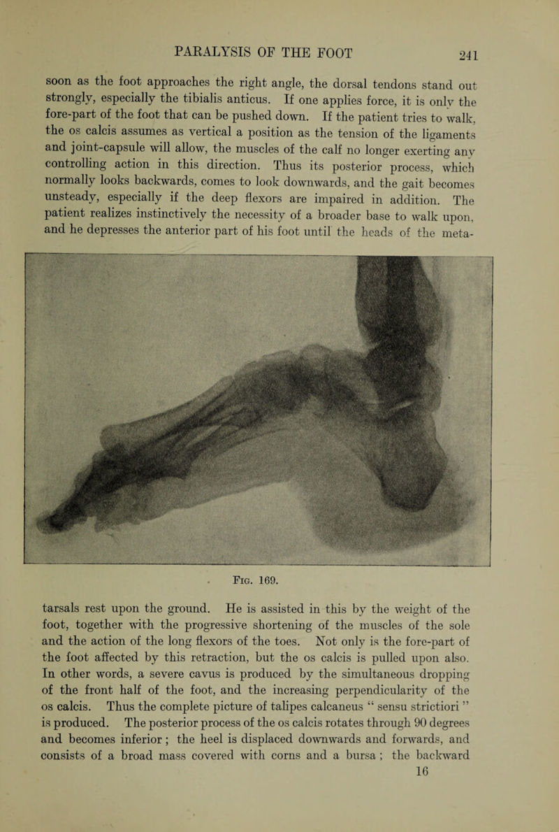 soon as the foot approaches the right angle, the dorsal tendons stand out strongly, especially the tibialis anticus. If one applies force, it is only the fore-part of the foot that can be pushed down. If the patient tries to walk, the os calcis assumes as vertical a position as the tension of the ligaments and joint-capsule will allow, the muscles of the calf no longer exerting any controlling action in this direction. Thus its posterior process, which normally looks backwards, comes to look downwards, and the gait becomes unsteady, especially if the deep flexors are impaired in addition. The patient realizes instinctively the necessity of a broader base to walk upon, and he depresses the anterior part of his foot until the heads of the meta- Fig. 169. tarsals rest upon the ground. He is assisted in this by the weight of the foot, together with the progressive shortening of the muscles of the sole and the action of the long flexors of the toes. Not only is the fore-part of the foot affected by this retraction, but the os calcis is pulled upon also. In other words, a severe cavus is produced by the simultaneous dropping of the front half of the foot, and the increasing perpendicularity of the os calcis. Thus the complete picture of talipes calcaneus “ sensu strictiori ” is produced. The posterior process of the os calcis rotates through 90 degrees and becomes inferior; the heel is displaced downwards and forwards, and consists of a broad mass covered with corns and a bursa; the backward 16