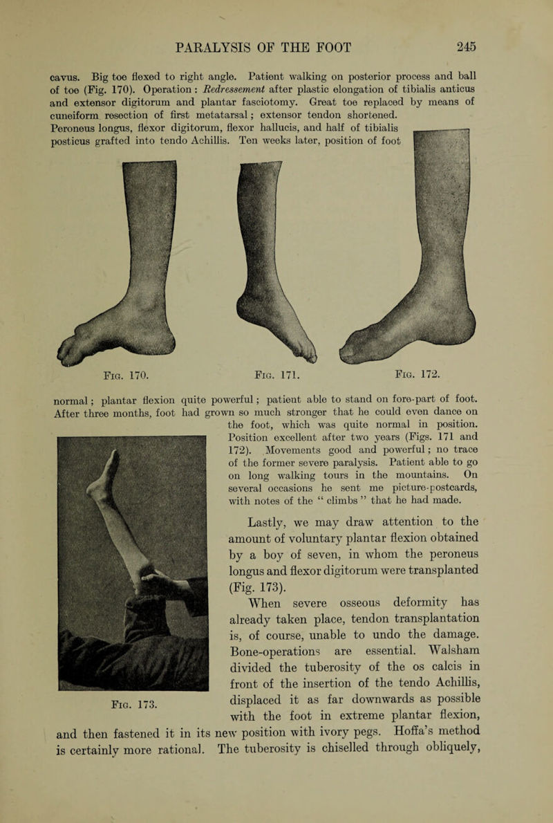 cavus. Big toe flexed to right angle. Patient walking on posterior process and ball of toe (Fig. 170). Operation : Redressement after plastic elongation of tibialis anticus and extensor digitorum and plantar fasciotomy. Great toe replaced by means of cuneiform resection of first metatarsal; extensor tendon shortened. Peroneus longus, flexor digitorum, flexor hallucis, and half of tibialis posticus grafted into tendo Achillis. Ten weeks later, position of foot Fig. 170. Fig. 171. Fig. 172. normal; plantar flexion quite powerful; patient able to stand on fore-part of foot. After three months, foot had grown so much stronger that he could even dance on the foot, which was quite normal in position. Position excellent after two years (Figs. 171 and 172). Movements good and powerful; no trace of the former severe paralysis. Patient able to go on long walking tours in the mountains. On several occasions he sent me picture-postcards, with notes of the “ climbs ” that he had made. Lastly, we may draw attention to the amount of voluntary plantar flexion obtained by a boy of seven, in whom the peroneus longus and flexor digitorum were transplanted (Fig. 173). When severe osseous deformity has already taken place, tendon transplantation is, of course, unable to undo the damage. Bone-operations are essential. Walsham divided the tuberosity of the os calcis in front of the insertion of the tendo Achillis, displaced it as far downwards as possible with the foot in extreme plantar flexion, and then fastened it in its new position with ivory pegs. Hoffa’s method is certainly more rational. The tuberosity is chiselled through obliquely, Fig. 173.