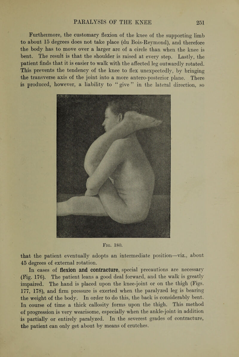 Furtheimore, the customary flexion of the knee of the supporting limb to about 15 degrees does not take place (du Bois-Reymond), and therefore the body has to move over a larger arc of a circle than when the knee is bent. The result is that the shoulder is raised at every step. Lastly, the patient finds that it is easier to walk with the affected leg outwardly rotated. This prevents the tendency of the knee to flex unexpectedly, by bringing the transverse axis of the joint into a more antero-posterior plane. There is produced, however, a liability to “ give ” in the lateral direction, so Fig. 180. that the patient eventually adopts an intermediate position—viz., about 45 degrees of external rotation. In cases of flexion and contracture, special precautions are necessary (Fig. 176). The patient leans a good deal forward, and the walk is greatly impaired. The hand is placed upon the knee-joint or on the thigh (Figs. 177, 178), and firm pressure is exerted when the paralyzed leg is bearing the weight of the body. In order to do this, the back is considerably bent. In course of time a thick callosity forms upon the thigh. This method of progression is very wearisome, especially when the ankle-joint in addition is partially or entirely paralyzed. In the severest grades of contracture, the patient can only get about by means of crutches.