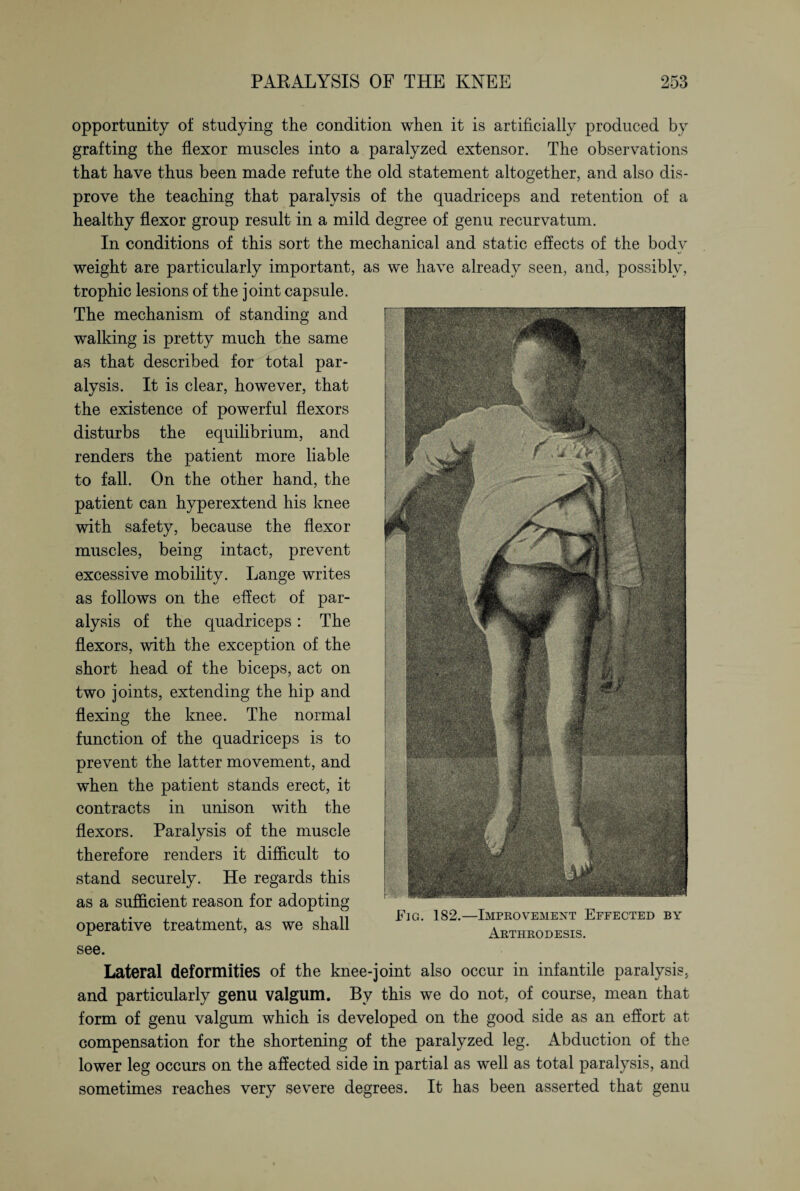 opportunity of studying the condition when it is artificially produced by grafting the flexor muscles into a paralyzed extensor. The observations that have thus been made refute the old statement altogether, and also dis¬ prove the teaching that paralysis of the quadriceps and retention of a healthy flexor group result in a mild degree of genu recurvatum. In conditions of this sort the mechanical and static effects of the body weight are particularly important, as we have already seen, and, possibly, trophic lesions of the joint capsule. The mechanism of standing and walking is pretty much the same as that described for total par¬ alysis. It is clear, however, that the existence of powerful flexors disturbs the equilibrium, and renders the patient more liable to fall. On the other hand, the patient can hyperextend his knee with safety, because the flexor muscles, being intact, prevent excessive mobility. Lange writes as follows on the effect of par¬ alysis of the quadriceps: The flexors, with the exception of the short head of the biceps, act on two joints, extending the hip and flexing the knee. The normal function of the quadriceps is to prevent the latter movement, and when the patient stands erect, it contracts in unison with the flexors. Paralysis of the muscle therefore renders it difficult to stand securely. He regards this as a sufficient reason for adopting operative treatment, as we shall see. Lateral deformities of the knee-joint also occur in infantile paralysis, and particularly genu valgum. By this we do not, of course, mean that form of genu valgum which is developed on the good side as an effort at compensation for the shortening of the paralyzed leg. Abduction of the lower leg occurs on the affected side in partial as well as total paralysis, and sometimes reaches very severe degrees. It has been asserted that genu Fig. 182.—Improvement Effected by Arthrodesis.