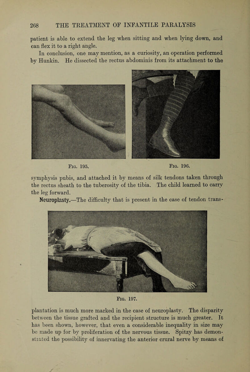 patient is able to extend the leg when sitting and when lying down, and can flex it to a right angle. In conclusion, one may mention, as a curiosity, an operation performed by Hunkin. He dissected the rectus abdominis from its attachment to the Fig. 195. Fig. 196. symphysis pubis, and attached it by means of silk tendons taken through the rectus sheath to the tuberosity of the tibia. The child learned to carry the leg forward. Neuroplasty.—The difficulty that is present in the case of tendon trans- Fig. 197. plantation is much more marked in the case of neuroplasty. The disparity between the tissue grafted and the recipient structure is much greater. It has been shown, however, that even a considerable inequality in size may be made up for by proliferation of the nervous tissue. Spitzy has demon¬ strated the possibility of innervating the anterior crural nerve by means of