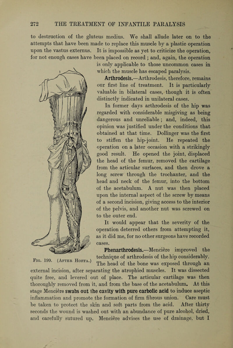 to destruction of the gluteus medius. We shall allude later on to the attempts that have been made to replace this muscle by a plastic operation upon the vastus externus. It is impossible as yet to criticize the operation, for not enough cases have been placed on record ; and, again, the operation is only applicable to those uncommon cases in which the muscle has escaped paralysis. Arthrodesis.—Arthrodesis, therefore, remains our first line of treatment. It is particularly valuable in bilateral cases, though it is often distinctly indicated in unilateral cases. In former days arthrodesis of the hip was regarded with considerable misgiving as being dangerous and unreliable; and, indeed, this opinion was justified under the conditions that obtained at that time. Dollinger was the first to stiffen the hip-joint. He repeated the operation on a later occasion with a strikingly good result. He opened the joint, displaced the head of the femur, removed the cartilage from the articular surfaces, and then drove a long screw through the trochanter, and the head and neck of the femur, into the bottom of the acetabulum. A nut was then placed upon the internal aspect of the screw by means of a second incision, giving access to the interior of the pelvis, and another nut was screwed on to the outer end. It would appear that the severity of the operation deterred others from attempting it, as it did me, for no other surgeons have recorded cases. Phenarthrodesis.—Menciere improved the technique of arthrodesis of the hip considerably. The head of the bone was exposed through an external incision, after separating the atrophied muscles. It was dissected quite free, and levered out of place. The articular cartilage was then thoroughly removed from it, and from the base of the acetabulum. At this stage Menciere swabs out the cavity with pure carbolic acid to induce aseptic inflammation and promote the formation of firm fibrous union. Care must be taken to protect the skin and soft parts from the acid. After thirty seconds the wound is washed out with an abundance of pure alcohol, dried, and carefully sutured up. Menciere advises the use of drainage, but I Fig. 199. (After Hoffa.)