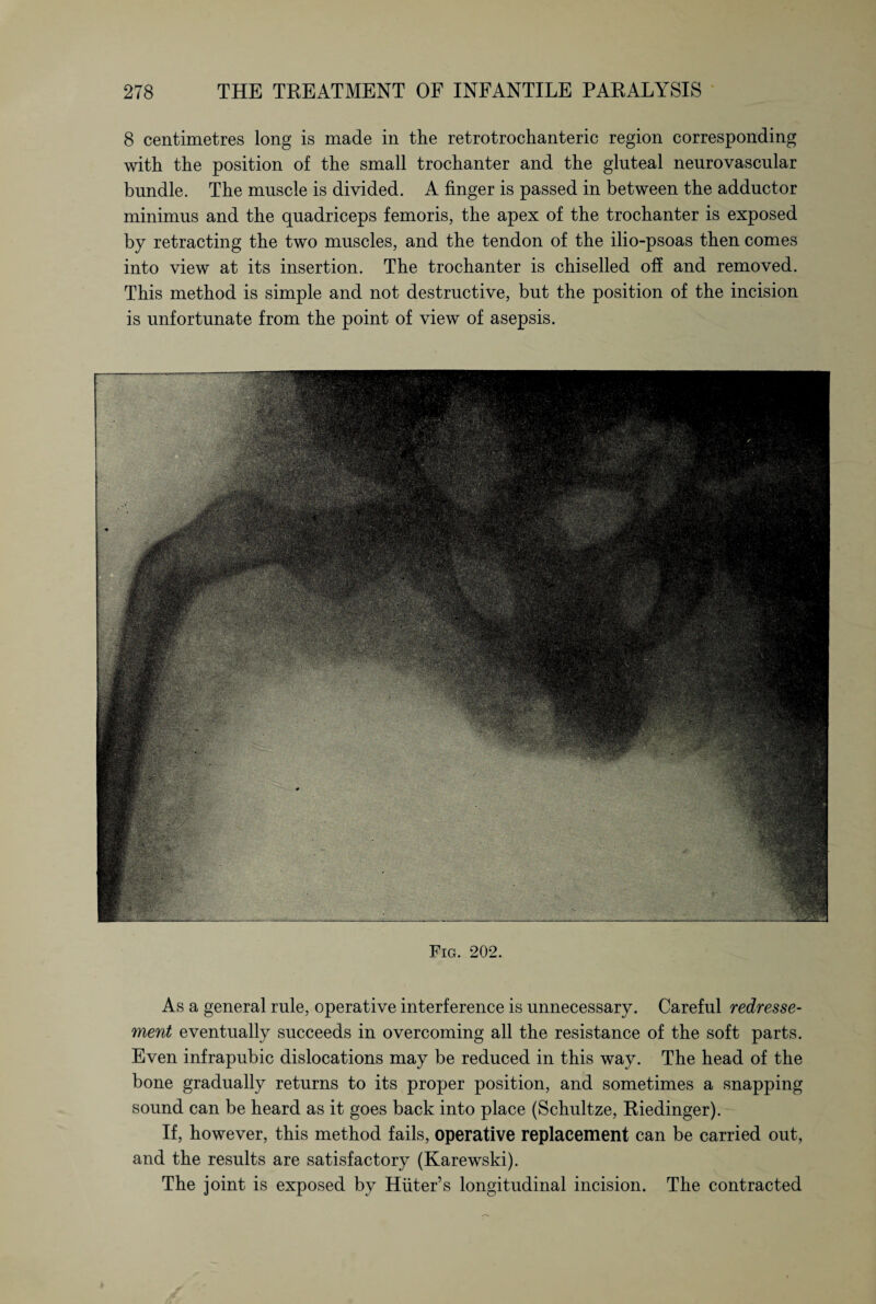 8 centimetres long is made in the retrotrochanteric region corresponding with the position of the small trochanter and the gluteal neurovascular bundle. The muscle is divided. A finger is passed in between the adductor minimus and the quadriceps femoris, the apex of the trochanter is exposed by retracting the two muscles, and the tendon of the ilio-psoas then comes into view at its insertion. The trochanter is chiselled off and removed. This method is simple and not destructive, but the position of the incision is unfortunate from the point of view of asepsis. Pig. 202. As a general rule, operative interference is unnecessary. Careful redresse- ment eventually succeeds in overcoming all the resistance of the soft parts. Even infrapubic dislocations may be reduced in this way. The head of the bone gradually returns to its proper position, and sometimes a snapping sound can be heard as it goes back into place (Schultze, Riedinger). If, however, this method fails, operative replacement can be carried out, and the results are satisfactory (Karewski). The joint is exposed by Hüter’s longitudinal incision. The contracted