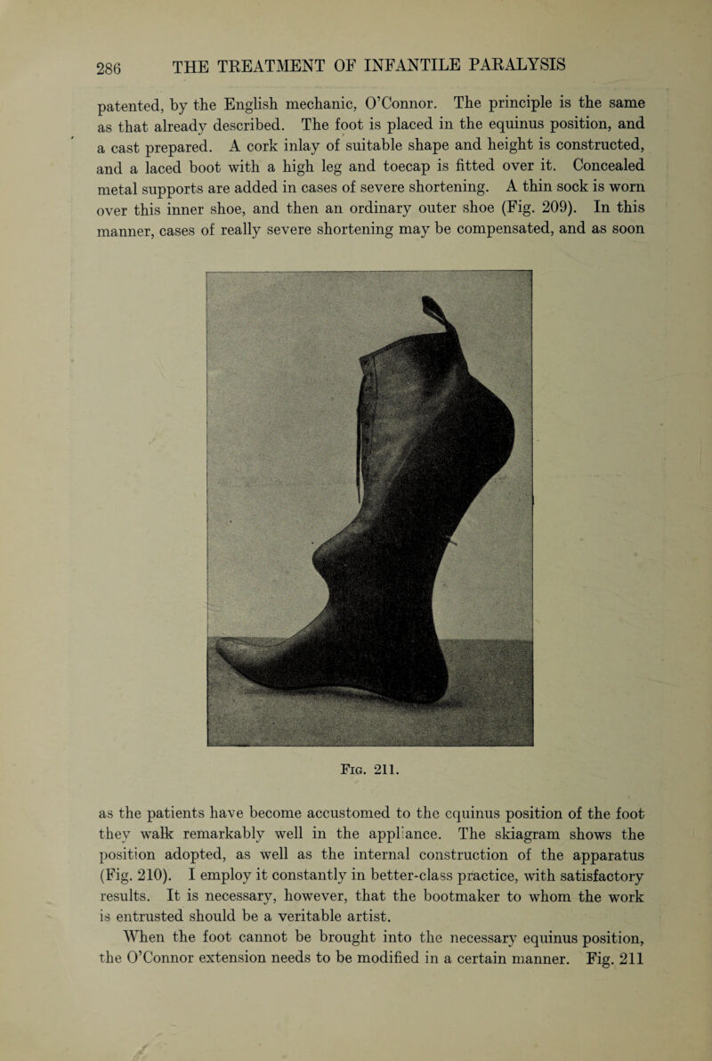 patented, by the English mechanic, O’Connor. The principle is the same as that already described. The foot is placed in the equinns position, and a cast prepared. A cork inlay of suitable shape and height is constructed, and a laced boot with a high leg and toecap is fitted over it. Concealed metal supports are added in cases of severe shortening. A thin sock is worn over this inner shoe, and then an ordinary outer shoe (Fig. 209). In this manner, cases of really severe shortening may be compensated, and as soon Fig. 211. as the patients have become accustomed to the cquinus position of the foot they walk remarkably well in the appliance. The skiagram shows the position adopted, as well as the internal construction of the apparatus (Fig. 210). I employ it constantly in better-class practice, with satisfactory results. It is necessary, however, that the bootmaker to whom the work is entrusted should be a veritable artist. When the foot cannot be brought into the necessary equinus position, the O’Connor extension needs to be modified in a certain manner. Fig. 211