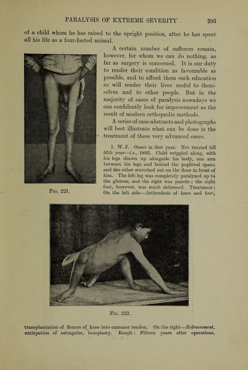 of a child whom he has raised to the upright position, after he has spent all his life as a four-footed animal. A certain number of sufferers remain, however, for whom we can do nothing, as far as surgery is concerned. It is our duty to render their condition as favourable as possible, and to afford them such education as will render their lives useful to them¬ selves and to other people. But in the majority of cases of paralysis nowadays we can confidently look for improvement as the result of modern orthopaedic methods. A series of case-abstracts and photographs will best illustrate what can be done in the treatment of these very advanced cases. 1. W. J. Onset in first year. Not treated till fifth year—i.e., 1893. Child wriggled along, with his legs drawn up alongside his body, one arm between his legs and behind the popliteal space, and the other stretched out on the floor in front of him. The left leg was completely paralyzed up to the gluteus, and the right was paretic ; the right foot, however, was much deformed. Treatment: On the left side—Arthrodesis of knee and foot. Fig. 221. Fig. 222. transplantation of flexors of knee into extensor tendon. On the right—Redressement, extirpation of astragalus, tenoplasty. Result: Fifteen years after operations,