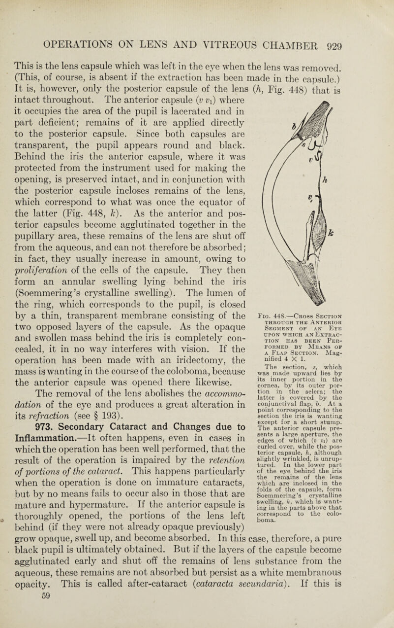 This is the lens capsule which was left in the eye when the lens was removed. (This, of course, is absent if the extraction has been made in the capsule.) It is, however, only the posterior capsule of the lens (h, Fig. 448) that is intact throughout. The anterior capsule (v vf) where it occupies the area of the pupil is lacerated and in part deficient; remains of it are applied directly to the posterior capsule. Since both capsules are transparent, the pupil appears round and black. Behind the iris the anterior capsule, where it was protected from the instrument used for making the opening, is preserved intact, and in conjunction with the posterior capsule incloses remains of the lens, which correspond to what was once the equator of the latter (Fig. 448, k). As the anterior and pos¬ terior capsules become agglutinated together in the pupillary area, these remains of the lens are shut off from the aqueous, and can not therefore be absorbed; in fact, they usually increase in amount, owing to proliferation of the cells of the capsule. They then form an annular swelling lying behind the iris (Soemmering’s crystalline swelling). The lumen of the ring, which corresponds to the pupil, is closed by a thin, transparent membrane consisting of the two opposed layers of the capsule. As the opaque and swollen mass behind the iris is completely con¬ cealed, it in no way interferes with vision. If the operation has been made with an iridectomy, the mass is wanting in the course of the coloboma, because the anterior capsule was opened there likewise. The removal of the lens abolishes the accommo¬ dation of the eye and produces a great alteration in its refraction (see § 193). 973. Secondary Cataract and Changes due to Inflammation.—It often happens, even in cases in which the operation has been well performed, that the result of the operation is impaired by the retention of portions of the cataract. This happens particularly when the operation is done on immature cataracts, but by no means fails to occur also in those that are mature and hypermature. If the anterior capsule is thoroughly opened, the portions of the lens left behind (if they were not already opaque previously) grow opaque, swell up, and become absorbed. In this case, therefore, a pure black pupil is ultimately obtained. But if the layers of the capsule become agglutinated early and shut off the remains of lens substance from the aqueous, these remains are not absorbed but persist as a white membranous opacity. This is called after-cataract (cataracta secundaria). If this is 59 Fig. 448.—Cross Section THROUGH THE ANTERIOR Segment of an Eye upon which an Extrac¬ tion has been Per¬ formed by Means of a Flap Section. Mag¬ nified 4X1. The section, s, which was made upward lies by its inner portion in the cornea, by its outer por¬ tion in the sclera; the latter is covered by the conjunctival flap, b. At a point corresponding to the section the iris is wanting except for a short stump. The anterior capsule pre¬ sents a large aperture, the edges of which (v Vi) are curled over, while the pos¬ terior capsule, h, although slightly wrinkled, is unrup¬ tured. In the lower part of the eye behind the iris the remains of the lens which are inclosed in the folds of the capsule, form Soemmering’s crystalline swelling, k, which is want¬ ing in the parts above that correspond to the colo¬ boma.