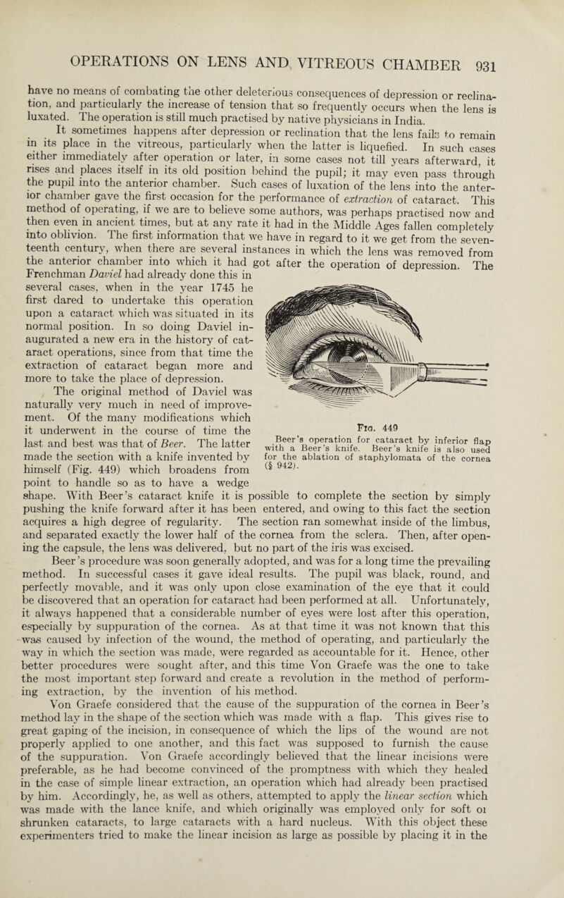 have no means of combating the other deleterious consequences of depression or reclina- tion, and particularly the increase of tension that so frequently occurs when the lens is luxated. The operation is still much practised by native physicians in India. It sometimes happens after depression or reclination that the lens fails to remain in its place in the vitreous, particularly when the latter is liquefied. In such cases either immediately after operation or later, in some cases not till years afterward, it rises and places itself in its old position behind the pupil,* it may even pass through the pupil into the anterior chamber. Such cases of luxation of the lens into the anter¬ ior chamber gave the first occasion for the performance of extraction of cataract. This method of operating, if we are to believe some authors, was perhaps practised now and then even in ancient times, but at any rate it had in the Middle Ages fallen completely into oblivion, q he first information that we have in regard to it we get from the seven¬ teenth century, when there are several instances in which the lens was removed from the anterior chamber into which it had got after the operation of depression. The Frenchman Daviel had already done this in several cases, when in the year 1745 he first dared to undertake this operation upon a cataract which was situated in its normal position. In so doing Daviel in¬ augurated a new era in the history of cat¬ aract operations, since from that time the extraction of cataract began more and more to take the place of depression. The original method of Daviel was naturally very much in need of improve¬ ment. Of the many modifications which it underwent in the course of time the last and best was that of Beer. The latter made the section with a knife invented by himself (Fig. 449) which broadens from point to handle so as to have a wedge shape. With Beer’s cataract knife it is possible to complete the section by simply pushing the knife forward after it has been entered, and owing to this fact the section acquires a high degree of regularity. The section ran somewhat inside of the limbus, and separated exactly the lower half of the cornea from the sclera. Then, after open¬ ing the capsule, the lens was delivered, but no part of the iris was excised. Beer ’s procedure was soon generally adopted, and was for a long time the prevailing method. In successful cases it gave ideal results. The pupil was black, round, and perfectly movable, and it was only upon close examination of the eye that it could be discovered that an operation for cataract had been performed at all. Unfortunately, it always happened that a considerable number of eyes were lost after this operation, especially by suppuration of the cornea. As at that time it was not known that this was caused by infection of the wound, the method of operating, and particularly the way in which the section was made, were regarded as accountable for it. Hence, other better procedures were sought after, and this time Von Graefe was the one to take the most important step forward and create a revolution in the method of perform¬ ing extraction, by the invention of his method. Von Graefe considered that the cause of the suppuration of the cornea in Beer’s method lay in the shape of the section which was made with a flap. This gives rise to great gaping of the incision, in consequence of which the lips of the wound are not properly applied to one another, and this fact was supposed to furnish the cause of the suppuration. Von Graefe accordingly believed that the linear incisions w*ere preferable, as he had become convinced of the promptness with which they healed in the case of simple linear extraction, an operation which had already been practised by him. Accordingly, he, as well as others, attempted to apply the linear section which was made with the lance knife, and which originally was employed only for soft oi shrunken cataracts, to large cataracts with a hard nucleus. With this object these experimenters tried to make the linear incision as large as possible by placing it in the Fig. 449 Beer’s operation for cataract by inferior flap with a Beer’s knife. Beer’s knife is also used for the ablation of staphylomata of the cornea (§ 942).