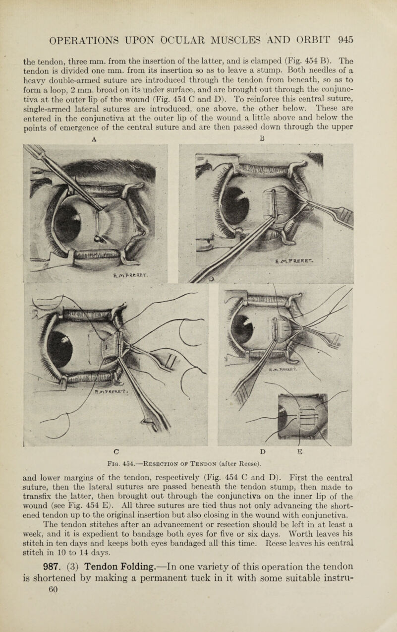 Fig. 454.—Resection of Tendon (after Reese). and lower margins of the tendon, respectively (Fig. 454 C and D). First the central suture, then the lateral sutures are passed beneath the tendon stump, then made to transfix the latter, then brought out through the conjunctiva on the inner lip of the wound (see Fig. 454 E). All three sutures are tied thus not only advancing the short¬ ened tendon up to the original insertion but also closing in the wound with conjunctiva. The tendon stitches after an advancement or resection should be left in at least a week, and it is expedient to bandage both eyes for five or six days. Worth leaves hia stitch in ten days and keeps both eyes bandaged all this time. Reese leaves his central stitch in 10 to 14 days. 987. (3) Tendon Folding.—In one variety of this operation the tendon is shortened by making a permanent tuck in it with some suitable instru- 60 OPERATIONS UPON OCULAR MUSCLES AND ORBIT 945 the tendon, three mm. from the insertion of the latter, and is clamped (Fig. 454 B). The tendon is divided one mm. from its insertion so as to leave a stump. Both needles of a heavy double-armed suture are introduced through the tendon from beneath, so as to form a loop, 2 mm. broad on its under surface, and are brought out through the conjunc¬ tiva at the outer lip of the wound (Fig. 454 C and D). To reinforce this central suture, single-armed lateral sutures are introduced, one above, the other below. These are entered in the conjunctiva at the outer lip of the wound a little above and below the points of emergence of the central suture and are then passed down through the upper A B E.M.V«UR£T, E/n.I^eftRT.