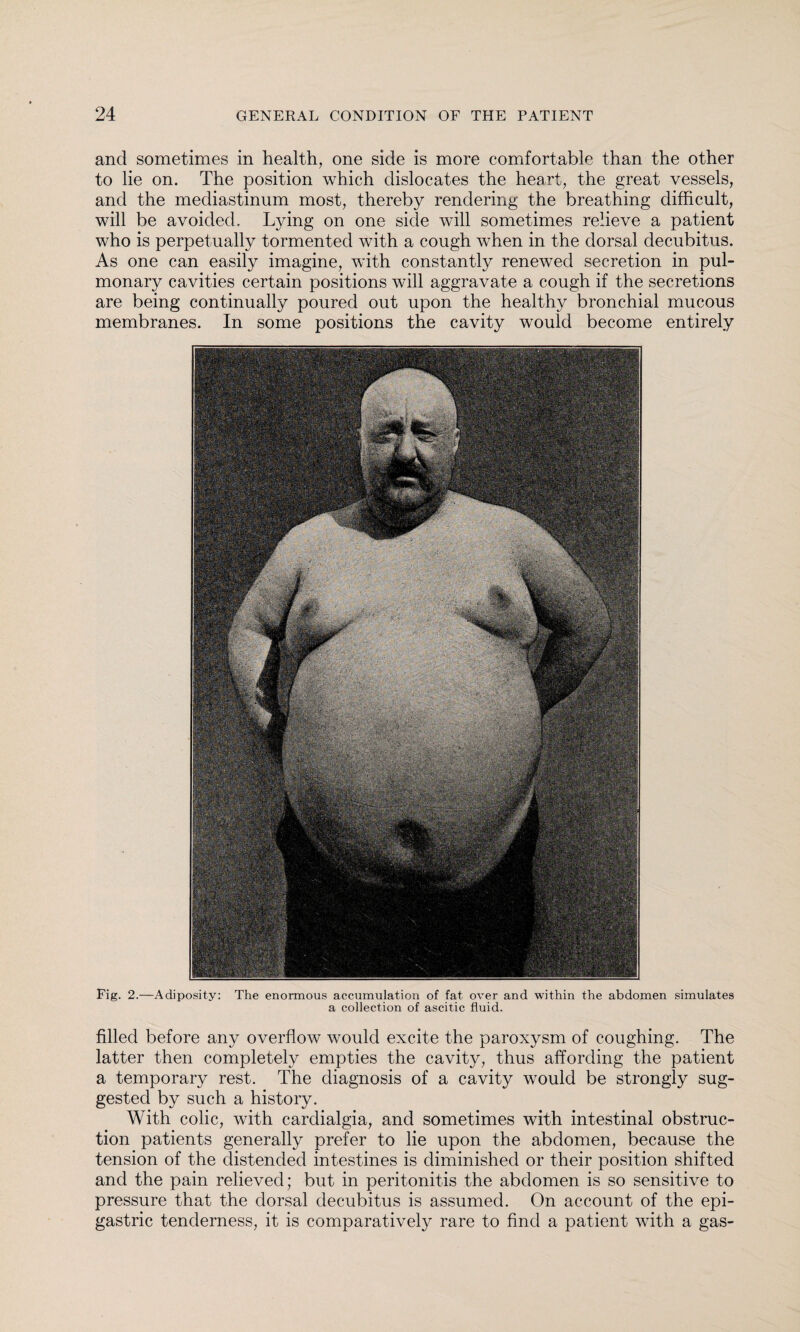 and sometimes in health, one side is more comfortable than the other to lie on. The position which dislocates the heart, the great vessels, and the mediastinum most, thereby rendering the breathing difficult, will be avoided. Lying on one side will sometimes relieve a patient who is perpetually tormented with a cough when in the dorsal decubitus. As one can easily imagine, with constantly renewed secretion in pul¬ monary cavities certain positions will aggravate a cough if the secretions are being continually poured out upon the healthy bronchial mucous membranes. In some positions the cavity would become entirely Fig. 2.—Adiposity: The enormous accumulation of fat over and within the abdomen simulates a collection of ascitic fluid. filled before any overflow would excite the paroxysm of coughing. The latter then completely empties the cavity, thus affording the patient a temporary rest. The diagnosis of a cavity would be strongly sug¬ gested by such a history. With colic, with cardialgia, and sometimes with intestinal obstruc¬ tion patients generally prefer to lie upon the abdomen, because the tension of the distended intestines is diminished or their position shifted and the pain relieved; but in peritonitis the abdomen is so sensitive to pressure that the dorsal decubitus is assumed. On account of the epi¬ gastric tenderness, it is comparatively rare to find a patient with a gas-