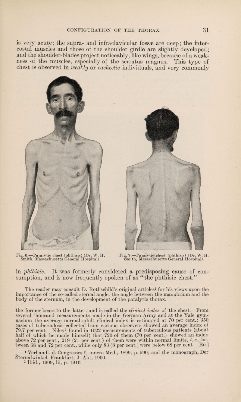 is very acute; the supra- and infraclavicular fossae are deep; the inter¬ costal muscles and those of the shoulder girdle are slightly developed; and the shoulder-blades project noticeably, like wings, because of a weak¬ ness of the muscles, especially of the serratus magnus. This type of chest is observed in weakly or cachectic individuals, and very commonly Fig. 6.—Paralytic chest (phthisis) (Dr. W. H. Smith, Massachusetts General Hospital). Fig. 7.—Paralytic chest (phthisis) (Dr. W. H. Smith, Massachusetts General Hospital). in 'phthisis. It was formerly considered a predisposing cause of con¬ sumption, and is now frequently spoken of as “the phthisic chest.” The reader may consult D. Rothschild's original articles1 for his views upon the importance of the so-called sternal angle, the angle between the manubrium and the body of the sternum, in the development of the paralytic thorax. the former bears to the latter, and is called the clinical index of the chest. From several thousand measurements made in the German Army and at the Yale gym¬ nasium the average normal adult clinical index is estimated at 70 per cent.; 350 cases of tuberculosis collected from various observers showed an average index of 79.7 per cent. Niles2 found in 1022 measurements of tuberculous patients (about half of which he made himself) that 720 of them (70 per cent.) showed an index above 72 per cent., 219 (21 per cent.) of them were within normal limits, i. e., be¬ tween 68 and 72 per cent., while only 83 (8 per cent.) were below 68 per cent.—Ed.] 1 Verhandl. d. Congresses f. innere Med., 1899, p. 590; and the monograph, Der Sternalwinkel, Frankfurt, J. Abt, 1900. 2 Ibid., 1909, lii, p. 1916.