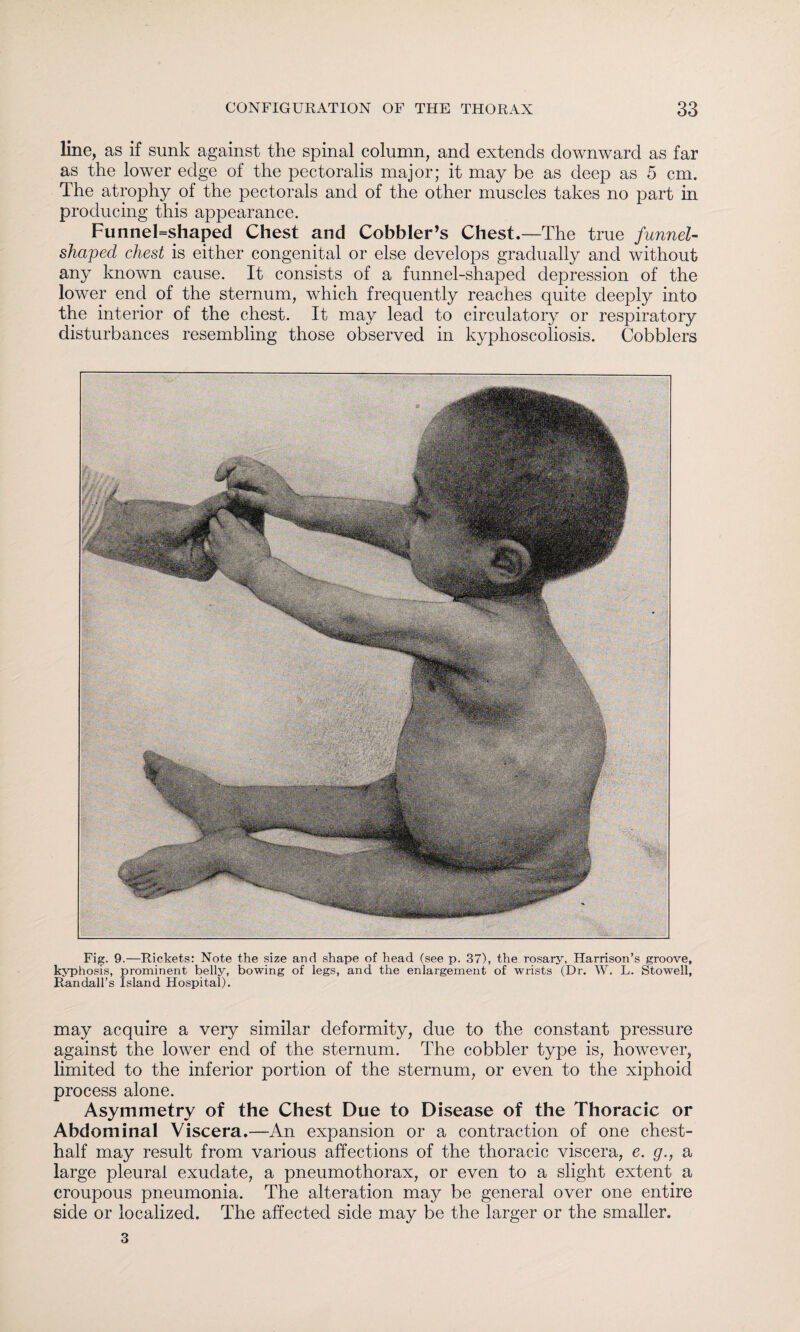 line, as if sunk against the spinal column, and extends downward as far as the lower edge of the pectoralis major; it may be as deep as 5 cm. The atrophy of the pectorals and of the other muscles takes no part in producing this appearance. Funnel=shaped Chest and Cobbler’s Chest.—The true funnel- shaped chest is either congenital or else develops gradually and without any known cause. It consists of a funnel-shaped depression of the lower end of the sternum, which frequently reaches quite deeply into the interior of the chest. It may lead to circulatory or respiratory disturbances resembling those observed in kyphoscoliosis. Cobblers Fig. 9.—Rickets: Note the size and shape of head (see p. 37), the rosary, Harrison’s groove, kyphosis, prominent belly, bowing of legs, and the enlargement of wrists (Dr. W. L. Stowell, Randall’s Island Hospital). may acquire a very similar deformity, due to the constant pressure against the lower end of the sternum. The cobbler type is, however, limited to the inferior portion of the sternum, or even to the xiphoid process alone. Asymmetry of the Chest Due to Disease of the Thoracic or Abdominal Viscera.—An expansion or a contraction of one chest- half may result from various affections of the thoracic viscera, e. g., a large pleural exudate, a pneumothorax, or even to a slight extent a croupous pneumonia. The alteration may be general over one entire side or localized. The affected side may be the larger or the smaller. 3