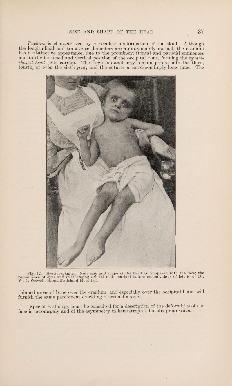 Rachitis is characterized by a peculiar malformation of the skull. Although the longitudinal and transverse diameters are approximately normal, the cranium has a distinctive appearance, due to the prominent frontal and parietal eminences and to the flattened and vertical position of the occipital bone, forming the square- shaped head (tete carree). The large fontanel may remain patent into the third, fourth, or even the sixth year, and the sutures a correspondingly long time. The Fig. 12.—Hydrocephalus: Note size and shape of the head as compared with the face; the prominence of eyes and overhanging orbital roof; marked talipes equinovalgus of left foot (Dr. W. L. Stowell, Randall’s Island Hospital). thinned areas of bone over the cranium, and especially over the occipital bone, will furnish the same parchment crackling described above.1 1 Special Pathology must be consulted for a description of the deformities of the face in acromegaly and of the asymmetry in hemiatrophia facialis progressiva.