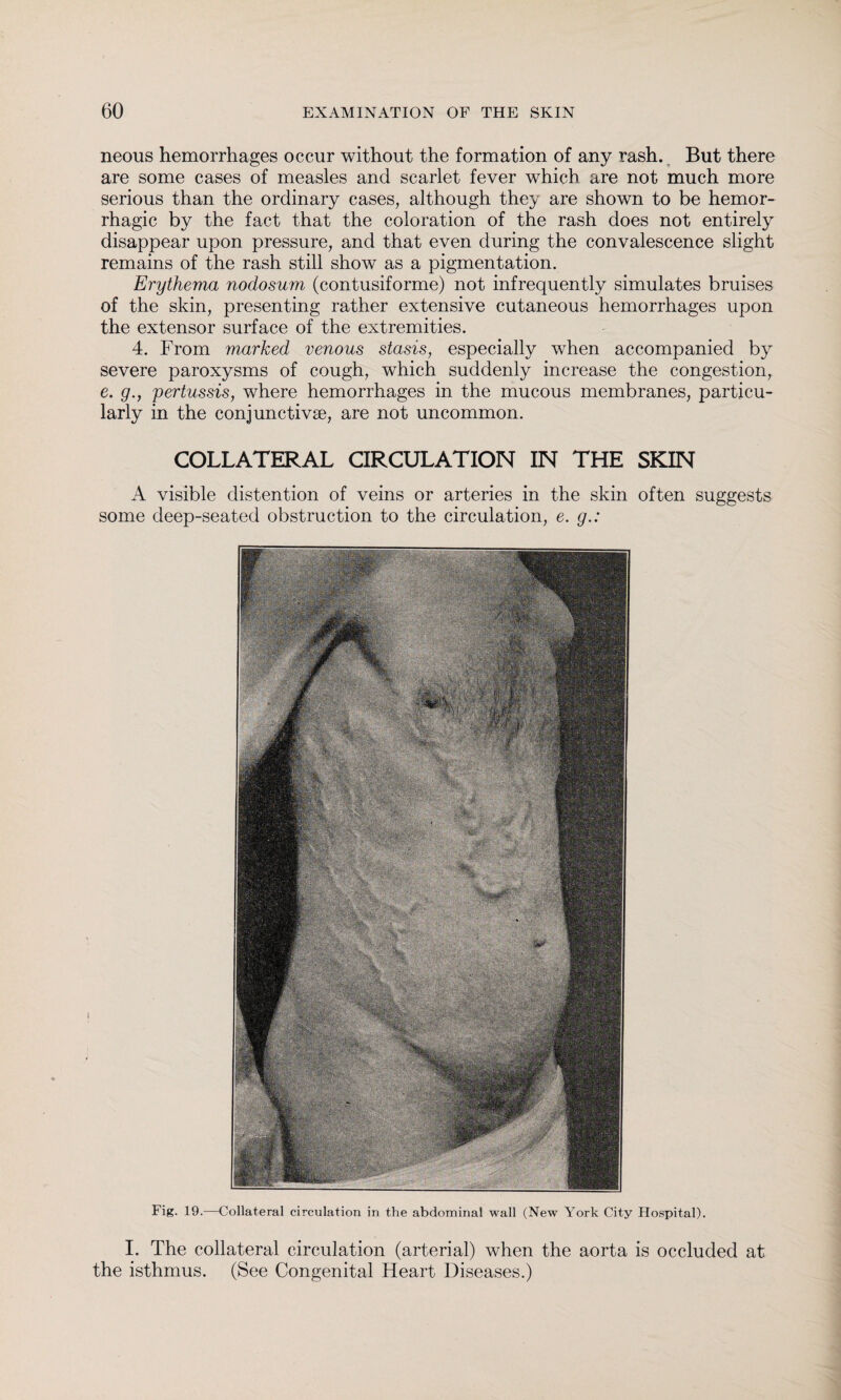 neous hemorrhages occur without the formation of any rash. But there are some cases of measles and scarlet fever which are not much more serious than the ordinary cases, although they are shown to be hemor¬ rhagic by the fact that the coloration of the rash does not entirely disappear upon pressure, and that even during the convalescence slight remains of the rash still show as a pigmentation. Erythema nodosum (contusiforme) not infrequently simulates bruises of the skin, presenting rather extensive cutaneous hemorrhages upon the extensor surface of the extremities. 4. From marked venous stasis, especially when accompanied by severe paroxysms of cough, which suddenly increase the congestion, e. g., pertussis, where hemorrhages in the mucous membranes, particu¬ larly in the conjunctivae, are not uncommon. COLLATERAL CIRCULATION IN THE SKIN A visible distention of veins or arteries in the skin often suggests some deep-seated obstruction to the circulation, e. g.: Fig. 19.—Collateral circulation in the abdominal wall (New York City Hospital). I. The collateral circulation (arterial) when the aorta is occluded at the isthmus. (See Congenital Heart Diseases.)