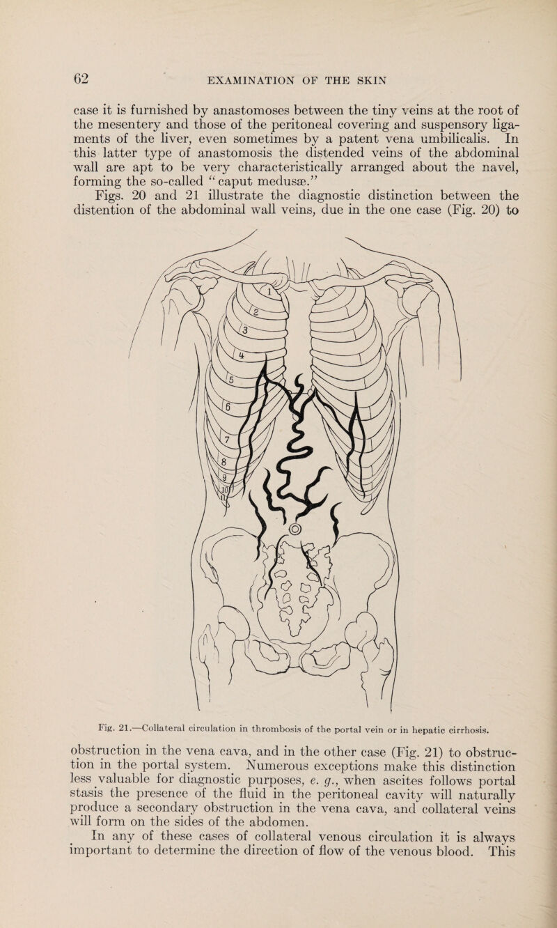 case it is furnished by anastomoses between the tiny veins at the root of the mesentery and those of the peritoneal covering and suspensory liga¬ ments of the liver, even sometimes by a patent vena umbilicalis. In this latter type of anastomosis the distended veins of the abdominal wall are apt to be very characteristically arranged about the navel, forming the so-called “ caput medusae.” Figs. 20 and 21 illustrate the diagnostic distinction between the distention of the abdominal wall veins, due in the one case (Fig. 20) to Fig. 21. Collateral circulation in thrombosis of the portal vein or in hepatic cirrhosis. obstruction in the vena cava, and in the other case (Fig. 21) to obstruc¬ tion in the portal system. Numerous exceptions make this distinction less valuable for diagnostic purposes, e. g., when ascites follows portal stasis the presence of the fluid in the peritoneal cavity will naturally produce a secondary obstruction in the vena cava, and collateral veins will form on the sides of the abdomen. In any of these cases of collateral venous circulation it is always important to determine the direction of flow of the venous blood. This