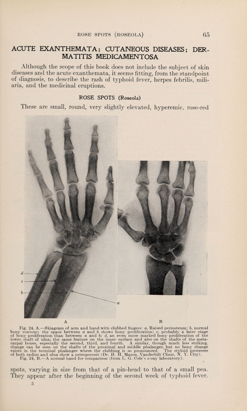 ACUTE EXANTHEMATA; CUTANEOUS DISEASES; DER¬ MATITIS MEDICAMENTOSA Although the scope of this book does not include the subject of skin diseases and the acute exanthemata, it seems fitting, from the standpoint of diagnosis, to describe the rash of typhoid fever, herpes febrilis, mili¬ aria, and the medicinal eruptions. ROSE SPOTS (Roseola) These are small, round, very slightly elevated, hyperemic, rose-red A B Fig. 24, A.—Skiagram of arm and hand with clubbed fingers: a, Raised periosteum; b, normal bony contour; the space between a and b shows bony proliferation; c, probably a later stage of bony proliferation than between a and b; d, an even more marked bony proliferation of the lower shaft of ulna; the same feature on the inner surface and also on the shafts of the meta¬ carpal bones, especially the second, third, and fourth. A similar, though much less striking, change can be seen on the shafts of the proximal and middle phalanges, but no bony change exists in the terminal phalanges where the clubbing is so pronounced. The styloid processes of both radius and ulna show a osteoporosis (Dr. H. H. Mason, Vanderbilt Clinic, N. Y. City). Fig. 24, B.—A normal hand for comparison (from L. G. Cole’s .x-ray laboratory). spots, varying in size from that of a pin-head to that of a small pea. They appear after the beginning of the second week of typhoid fever. 5