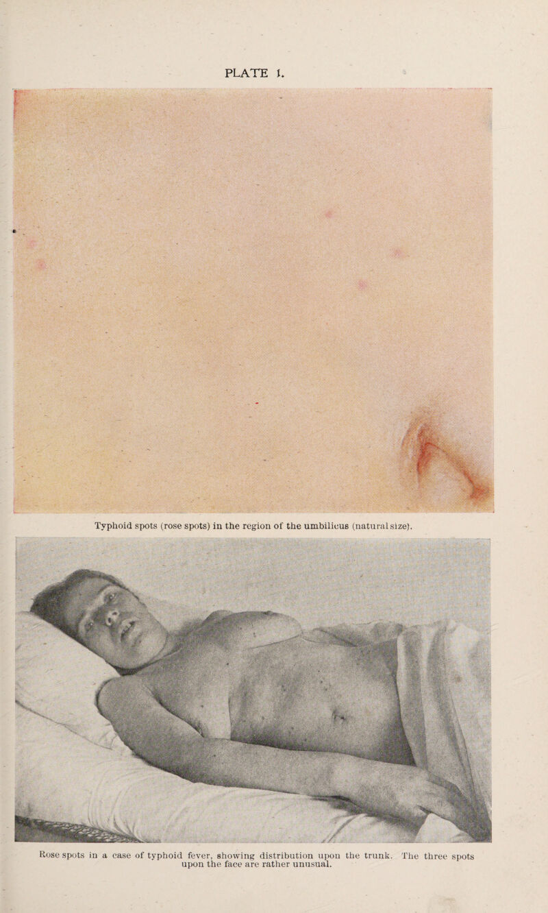 PLATE \ - ':0W, Typhoid spots (rose spots) in the region of the umbilicus (natural size). Rose spots in a case of typhoid fever, showing distribution upon the trunk. The three spots upon the face are rather unusual.