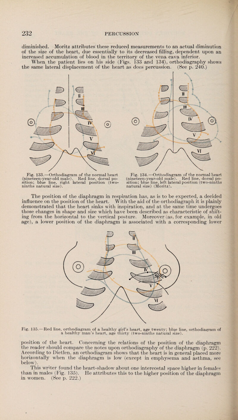 diminished. Moritz attributes these reduced measurements to an actual diminution of the size of the heart, due essentially to its decreased filling, dependent upon an increased accumulation of blood in the territory of the vena cava inferior. When the patient lies on his side (Figs. 133 and 134), orthodiagraphy shows the same lateral displacement of the heart as does percussion. (See p. 240.) Fig. 133.—Orthodiagram of the normal heart (nineteen-year-old male). Red line, dorsal po¬ sition; blue line, right lateral position (two- ninths natural size). Fig. 134.—Orthodiagram of the normal heart (nineteen-year-old male). Red line, dorsal po¬ sition; blue line, left lateral position (two-ninths natural size) (Moritz). The position of the diaphragm in respiration has, as is to be expected, a decided influence on the position of the heart. With the aid of the orthodiagraph it is plainly demonstrated that the heart sinks with inspiration, and at the same time undergoes those changes in shape and size which have been described as characteristic of shift¬ ing from the horizontal to the vertical posture. Moreover (as, for example, in old age), a lower position of the diaphragm is associated with a corresponding lower Fig. 135.—Red line, orthodiagram of a healthy girl’s heart, age twenty; blue line, orthodiagram of a healthy man’s heart, age thirty (two-ninths natural size). position of the heart. Concerning the relations of the position of the diaphragm the reader should compare the notes upon orthodiagraphy of the diaphragm (p. 222). According to Dietlen, an orthodiagram shows that the heart is in general placed more horizontally when the diaphragm is low (except in emphysema and asthma, see below). This writer found the heart-shadow about one intercostal space higher in females than in males (Fig. 135). He attributes this to the higher position of the diaphragm in women. (See p. 222.)