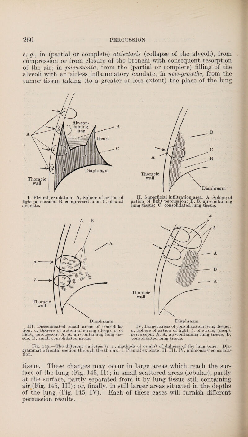 e. g., in (partial or complete) atelectasis (collapse of the alveoli), from compression or from closure of the bronchi with consequent resorption of the air; in pneumonia, from the (partial or complete) filling of the alveoli with an airless inflammatory exudate; in new-growths, from the tumor tissue taking (to a greater or less extent) the place of the lung / I. Pleural exudation: A, Sphere of action of light percussion; B, compressed lung; C, pleural exudate. II. Superficial infiltration area: A, Sphere of action of light percussion; B, B, air-containing lung tissue; C, consolidated lung tissue. A B III. Disseminated small areas of consolida¬ tion: a, Sphere of action of strong (deep), b, of light, percussion; A, A, air-containing lung tis¬ sue; B, small consolidated areas. a Diaphragm IV. Larger areas of consolidation lying deeper: a, Sphere of action of light, b, of strong (deep), percussion; A, A, air-containing lung tissue; B, consolidated lung tissue. Fig. 145.—The different varieties (i. e.. methods of origin) of dulness of the lung tone. Dia¬ grammatic frontal section through the thorax: I, Pleural exudate; II, III, IV, pulmonary consolida¬ tion. tissue. These changes may occur in large areas which reach the sur¬ face of the lung (Fig. 145, II); in small scattered areas (lobular), partly at the surface, partly separated from it by lung tissue still containing air (Fig. 145, III); or, finally, in still larger areas situated in the depths of the lung (Fig. 145, IY). Each of these cases will furnish different percussion results.