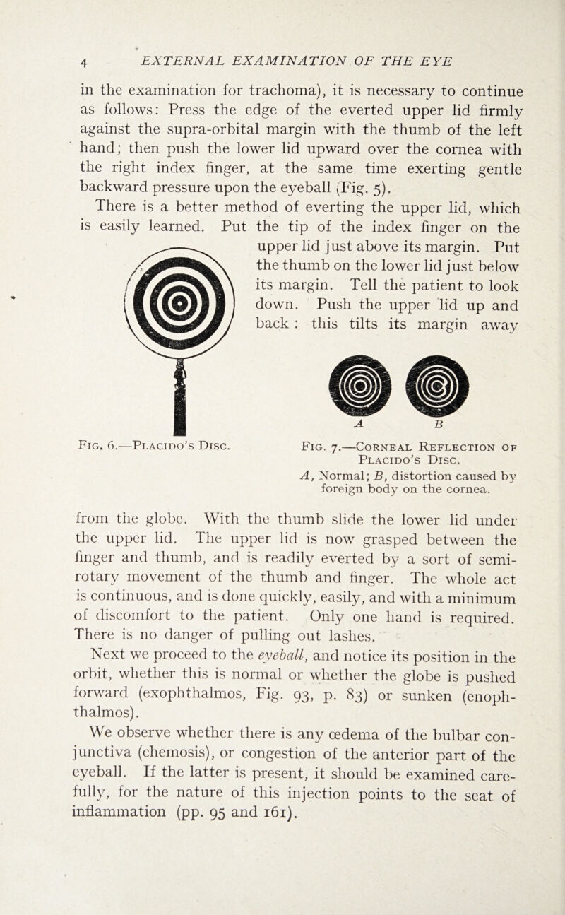 Fig. 6.—Placido’s Disc. Fig. 7.—Corneal Reflection of Placido's Disc. A, Normal; B, distortion caused by foreign body on the cornea. from the globe. With the thumb slide the lower lid under the upper lid. The upper lid is now grasped between the finger and thumb, and is readily everted by a sort of semi¬ rotary movement of the thumb and finger. The whole act is continuous, and is done quickly, easily, and with a minimum of discomfort to the patient. Only one hand is required. There is no danger of pulling out lashes. Next we proceed to the eyeball, and notice its position in the orbit, whether this is normal or whether the globe is pushed forward (exophthalmos, Fig. 93, p. 83) or sunken (enoph- thalmos). We observe whether there is any oedema of the bulbar con¬ junctiva (chemosis), or congestion of the anterior part of the eyeball. If the latter is present, it should be examined care¬ fully, for the nature of this injection points to the seat of inflammation (pp. 95 and 161). in the examination for trachoma), it is necessary to continue as follows: Press the edge of the everted upper lid firmly against the supra-orbital margin with the thumb of the left hand; then push the lower lid upward over the cornea with the right index finger, at the same time exerting gentle backward pressure upon the eyeball (Fig. 5). There is a better method of everting the upper lid, which is easily learned. Put the tip of the index finger on the upper lid just above its margin. Put the thumb on the lower lid just below its margin. Tell the patient to look down. Push the upper lid up and back : this tilts its margin away