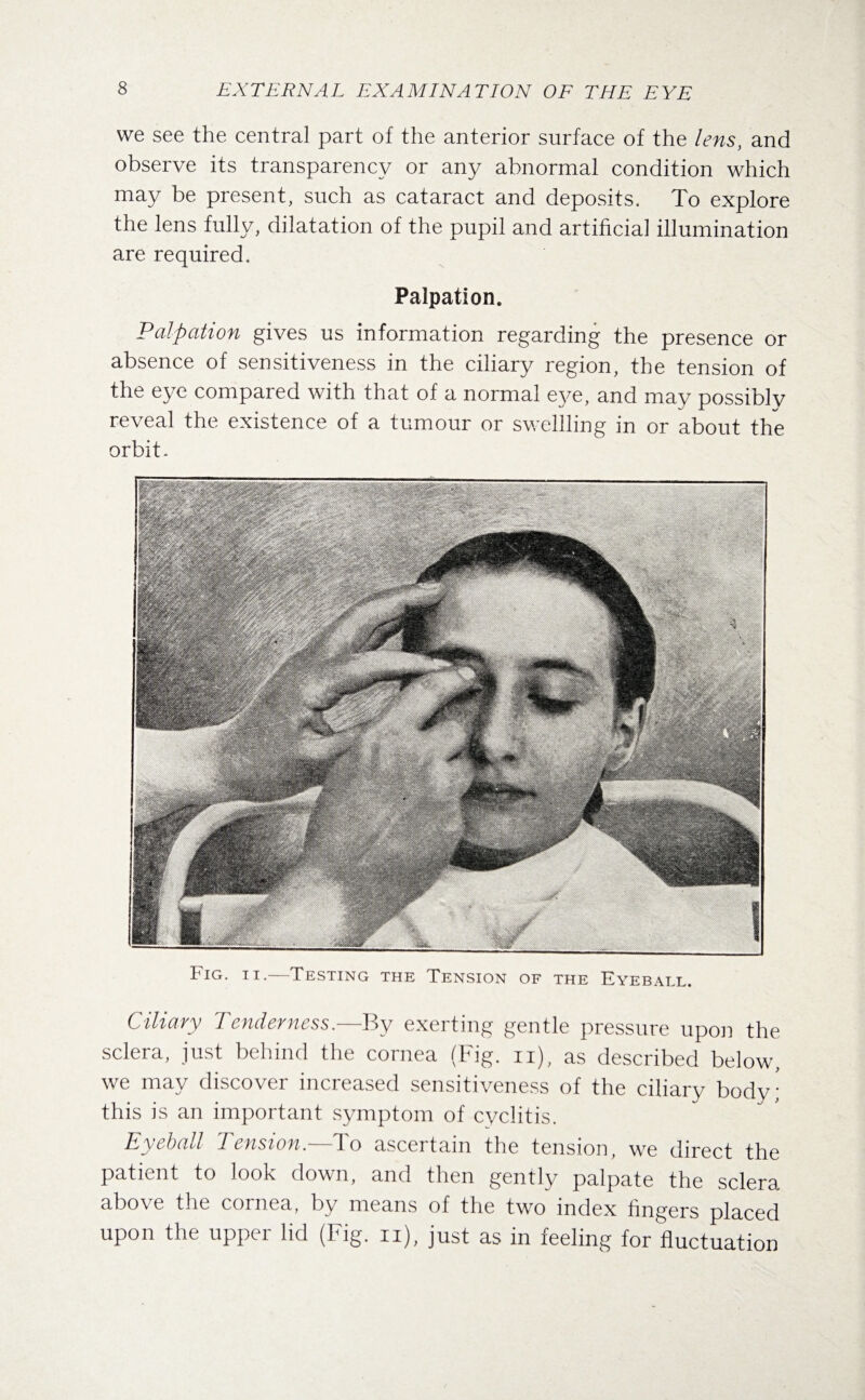 we see the central part of the anterior surface of the lens, and observe its transparency or any abnormal condition which may be present, such as cataract and deposits. To explore the lens fully, dilatation of the pupil and artificial illumination are required. Palpation. Palpation gives us information regarding the presence or absence of sensitiveness in the ciliary region, the tension of the eye compared with that of a normal eye, and may possiblv reveal the existence of a tumour or swellling in or about the orbit . Fig. ii.—Testing the Tension of the Eyeball. Ciliary Tenderness.—By exerting gentle pressure upon the sclera, just behind the cornea (Fig. ii), as described below, we may discover increased sensitiveness of the ciliary body; this is an important symptom of cyclitis. Eyeball Tension.—To ascertain the tension, we direct the patient to look down, and then gently palpate the sclera above the cornea, by means of the two index fingers placed upon the upper lid (Fig. ii), just as in feeling for fluctuation
