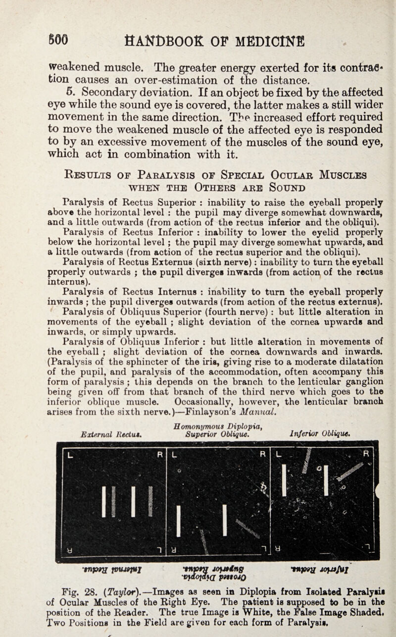 weakened muscle. The greater energy exerted for its contrac¬ tion causes an over-estimation of the distance. 5. Secondary deviation. If an object be fixed by the affected eye while the sound eye is covered, the latter makes a still wider movement in the same direction. The increased effort required to move the weakened muscle of the affected eye is responded to by an excessive movement of the muscles of the sound eye, which act in combination with it. Results of Paralysis of Special Ocular Muscles when the Others are Sound Paralysis of Rectus Superior : inability to raise the eyeball properly above the horizontal level : the pupil may diverge somewhat downwards, and a little outwards (from action of the rectus inferior and the obliqui). Paralysis of Rectus Inferior : inability to lower the eyelid properly below the horizontal level ; the pupil may diverge somewhat upwards, and a little outwards (from action of the rectus superior and the obliqui). Paralysis of Rectus Externus (sixth nerve): inability to turn the eyeball properly outwards ; the pupil diverges inwards (from action of the rectus internus). Paralysis of Rectus Internus : inability to turn the eyeball properly inwards ; the pupil diverges outwards (from action of the rectus externus). Paralysis of Obliquus Superior (fourth nerve) : but little alteration in movements of the eyeball ; slight deviation of the cornea upwards and inwards, or simply upwards. Paralysis of Obliquus Inferior : but little alteration in movements of the eyeball ; slight deviation of the cornea downwards and inwards. (Paralysis of the sphincter of the iris, giving rise to a moderate dilatation of the pupil, and paralysis of the accommodation, often accompany this form of paralysis ; this depends on the branch to the lenticular ganglion being given off from that branch of the third nerve which goes to the inferior oblique muscle. Occasionally, however, the lenticular branch arises from the sixth nerve.)—Finlayson’s Manual. External Rectus. Homonymous Diplopia, Superior Oblique. Inferior Oblique. snprx jvuu9p$j tt»p#57 jofjfdng fnpey jofjjfuj 'vtdojatd psnojQ Fig. 28. (Taylor).—Images as seen in Diplopia from Isolated Paralysis of Ocular Muscles of the Right Eye. The patient is supposed to be in the position of the Reader. The true Image is White, the False Image Shaded. Two Positions in the Field are given for each form of Paralysis,