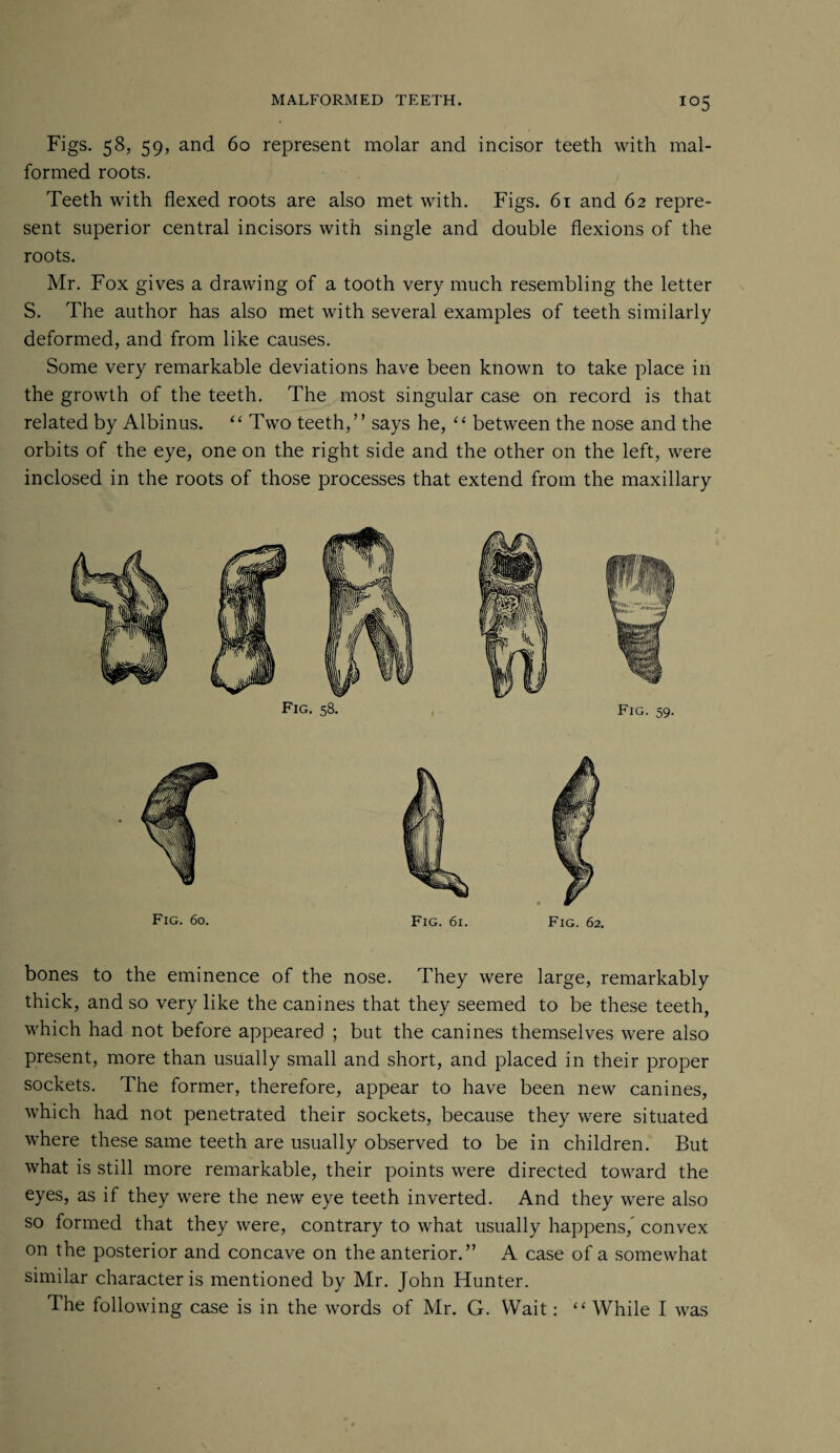 io5 Figs. 58, 59, and 60 represent molar and incisor teeth with mal¬ formed roots. Teeth with flexed roots are also met with. Figs. 61 and 62 repre¬ sent superior central incisors with single and double flexions of the roots. Mr. Fox gives a drawing of a tooth very much resembling the letter S. The author has also met with several examples of teeth similarly deformed, and from like causes. Some very remarkable deviations have been known to take place in the growth of the teeth. The most singular case on record is that related by Albinus. “ Two teeth,” says he, “ between the nose and the orbits of the eye, one on the right side and the other on the left, were inclosed in the roots of those processes that extend from the maxillary Fig. 60. Fig. 6i. Fig. 62. bones to the eminence of the nose. They were large, remarkably thick, and so very like the canines that they seemed to be these teeth, which had not before appeared ; but the canines themselves were also present, more than usually small and short, and placed in their proper sockets. The former, therefore, appear to have been new canines, which had not penetrated their sockets, because they were situated where these same teeth are usually observed to be in children. But what is still more remarkable, their points were directed toward the eyes, as if they were the new eye teeth inverted. And they were also so formed that they were, contrary to what usually happens/ convex on the posterior and concave on the anterior.” A case of a somewhat similar character is mentioned by Mr. John Hunter. The following case is in the words of Mr. G. Wait: “ While I was