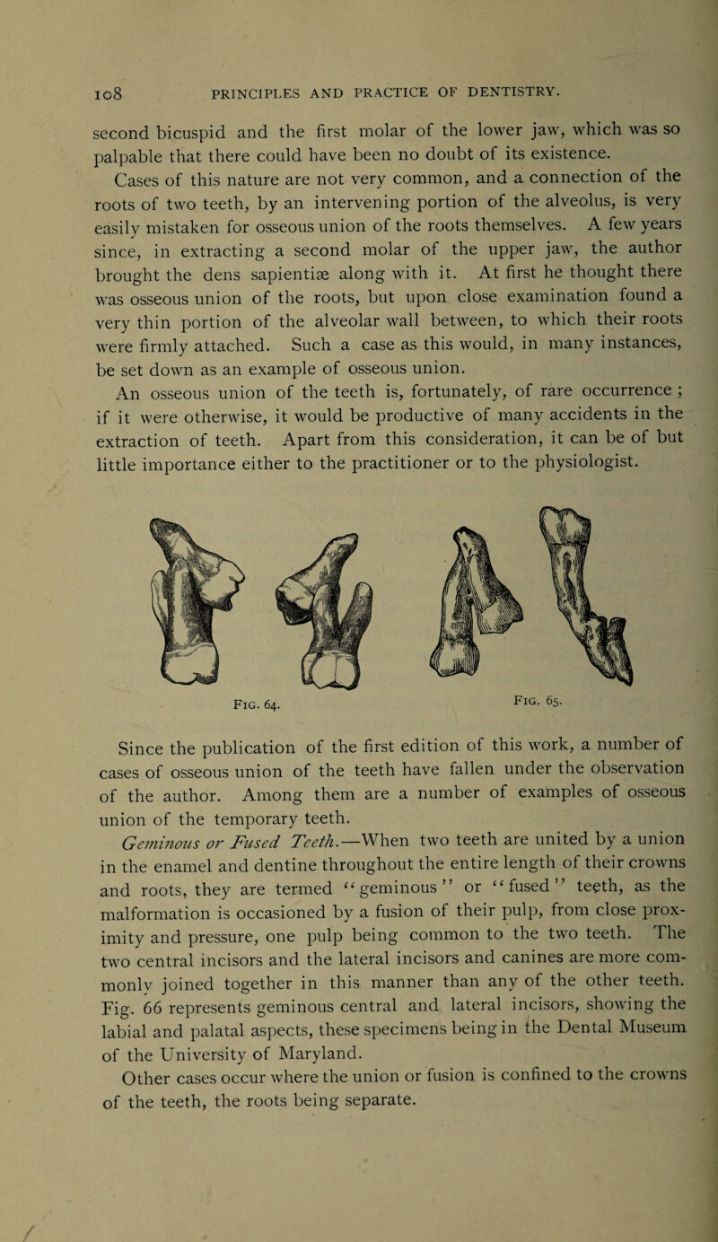 second bicuspid and the first molar of the lower jaw, which was so palpable that there could have been no doubt of its existence. Cases of this nature are not very common, and a connection of the roots of two teeth, by an intervening portion of the alveolus, is very easily mistaken for osseous union of the roots themselves. A few years since, in extracting a second molar of the upper jaw, the author brought the dens sapientise along with it. At first he thought there was osseous union of the roots, but upon close examination found a very thin portion of the alveolar wall between, to which their roots were firmly attached. Such a case as this would, in many instances, be set down as an example of osseous union. An osseous union of the teeth is, fortunately, of rare occurrence ; if it were otherwise, it would be productive of many accidents in the extraction of teeth. Apart from this consideration, it can be of but little importance either to the practitioner or to the physiologist. Fig. 64. Fig. 65. Since the publication of the first edition of this work, a number of cases of osseous union of the teeth have fallen under the observation of the author. Among them are a number of examples of osseous union of the temporary teeth. Geminous or Fused Teeth— When two teeth are united by a union in the enamel and dentine throughout the entire length of their crowns and roots, they are termed “geminous” or “fused teeth, as the malformation is occasioned by a fusion of their pulp, from close prox¬ imity and pressure, one pulp being common to the two teeth. The two central incisors and the lateral incisors and canines are more com¬ monly joined together in this manner than any of the other teeth. Tig. 66 represents geminous central and lateral incisors, showing the labial and palatal aspects, these specimens being in the Dental Museum of the University of Maryland. Other cases occur where the union or fusion is confined to the crowns of the teeth, the roots being separate.