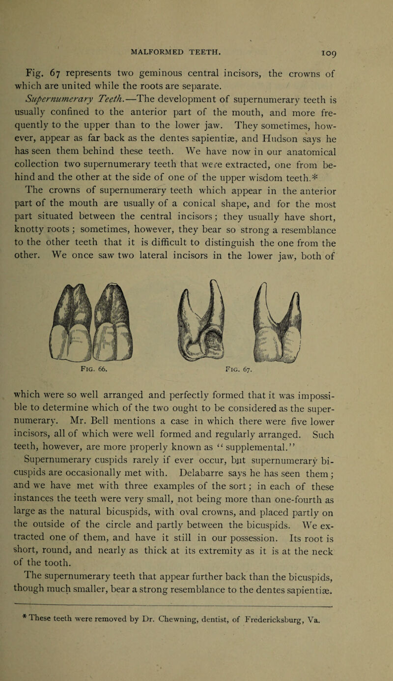 Fig. 67 represents two geminous central incisors, the crowns of which are united while the roots are separate. Supernumerary Teeth.—The development of supernumerary teeth is usually confined to the anterior part of the mouth, and more fre¬ quently to the upper than to the lower jaw. They sometimes, how¬ ever, appear as far back as the dentes sapientiae, and Hudson says he has seen them behind these teeth. We have now in our anatomical collection two supernumerary teeth that were extracted, one from be¬ hind and the other at the side of one of the upper wisdom teeth.* The crowns of supernumerary teeth which appear in the anterior part of the mouth are usually of a conical shape, and for the most part situated between the central incisors; they usually have short, knotty roots ; sometimes, however, they bear so strong a resemblance to the other teeth that it is difficult to distinguish the one from the other. We once saw two lateral incisors in the lower jaw, both of which were so well arranged and perfectly formed that it was impossi¬ ble to determine which of the two ought to be considered as the super¬ numerary. Mr. Bell mentions a case in which there were five lower incisors, all of which were well formed and regularly arranged. Such teeth, however, are more properly known as “ supplemental.” Supernumerary cuspids rarely if ever occur, but supernumerary bi¬ cuspids are occasionally met with. Delabarre says he has seen them; and we have met with three examples of the sort; in each of these instances the teeth were very small, not being more than one-fourth as large as the natural bicuspids, with oval crowns, and placed partly on the outside of the circle and partly between the bicuspids. We ex¬ tracted one of them, and have it still in our possession. Its root is short, round* and nearly as thick at its extremity as it is at the neck of the tooth. The supernumerary teeth that appear further back than the bicuspids, though much smaller, bear a strong resemblance to the dentes sapientiae. * These teeth were removed by Dr. Chewning, dentist, of Fredericksburg, Va.