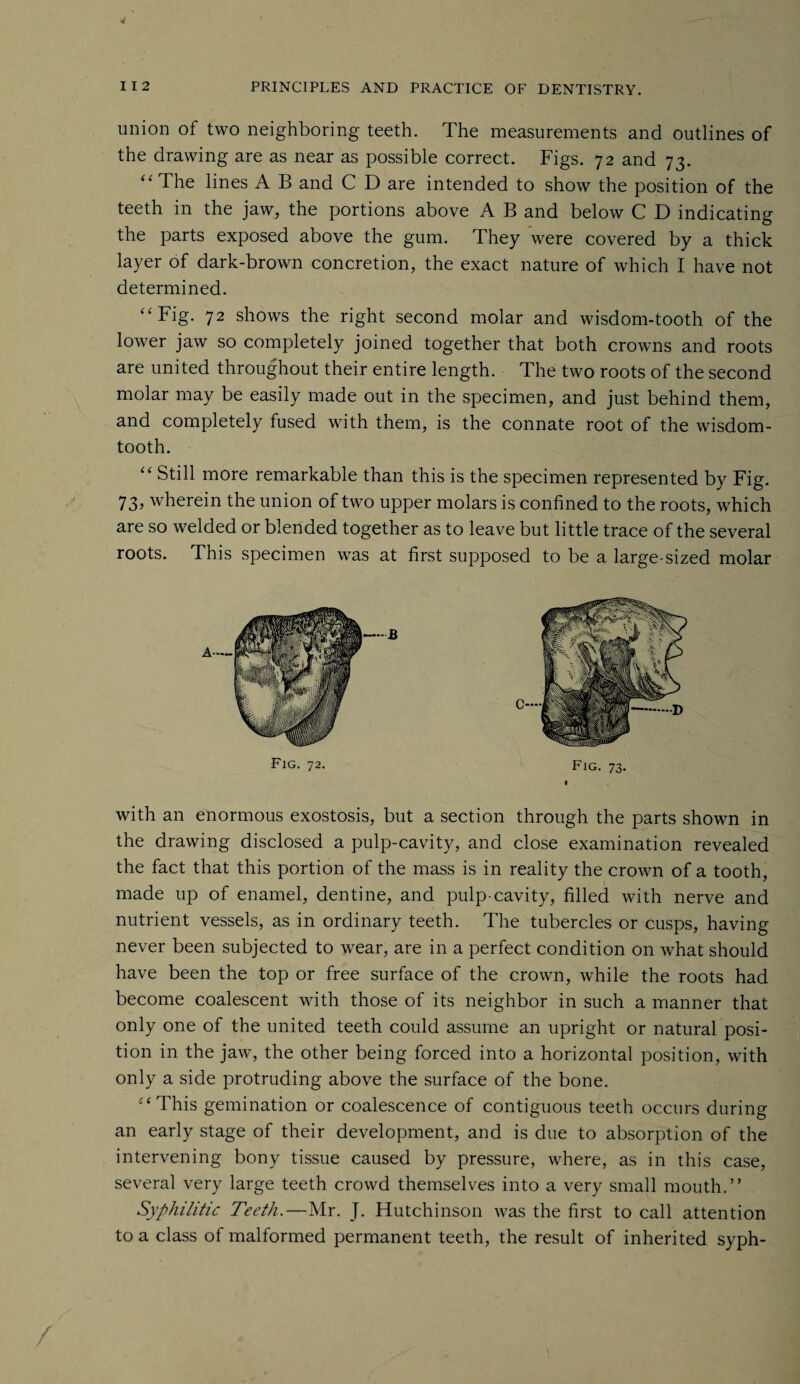 union of two neighboring teeth. The measurements and outlines of the drawing are as near as possible correct. Figs. 72 and 73. “ The lines A B and C D are intended to show the position of the teeth in the jaw, the portions above A B and below C D indicating the parts exposed above the gum. They were covered by a thick layer of dark-brown concretion, the exact nature of which I have not determined. “Fig. 72 shows the right second molar and wisdom-tooth of the lower jaw so completely joined together that both crowns and roots are united throughout their entire length. The two roots of the second molar may be easily made out in the specimen, and just behind them, and completely fused with them, is the connate root of the wisdom- tooth. “ Still more remarkable than this is the specimen represented by Fig. 73, wherein the union of two upper molars is confined to the roots, which are so welded or blended together as to leave but little trace of the several roots. This specimen was at first supposed to be a large-sized molar Fig. 72. Fig. 73. I with an enormous exostosis, but a section through the parts shown in the drawing disclosed a pulp-cavity, and close examination revealed the fact that this portion of the mass is in reality the crown of a tooth, made up of enamel, dentine, and pulp-cavity, filled with nerve and nutrient vessels, as in ordinary teeth. The tubercles or cusps, having never been subjected to wear, are in a perfect condition on what should have been the top or free surface of the crown, while the roots had become coalescent with those of its neighbor in such a manner that only one of the united teeth could assume an upright or natural posi¬ tion in the jaw, the other being forced into a horizontal position, with only a side protruding above the surface of the bone. “This gemination or coalescence of contiguous teeth occurs during an early stage of their development, and is due to absorption of the intervening bony tissue caused by pressure, where, as in this case, several very large teeth crowd themselves into a very small mouth.” Syphilitic Teeth.—Mr. J. Hutchinson was the first to call attention to a class of malformed permanent teeth, the result of inherited syph-