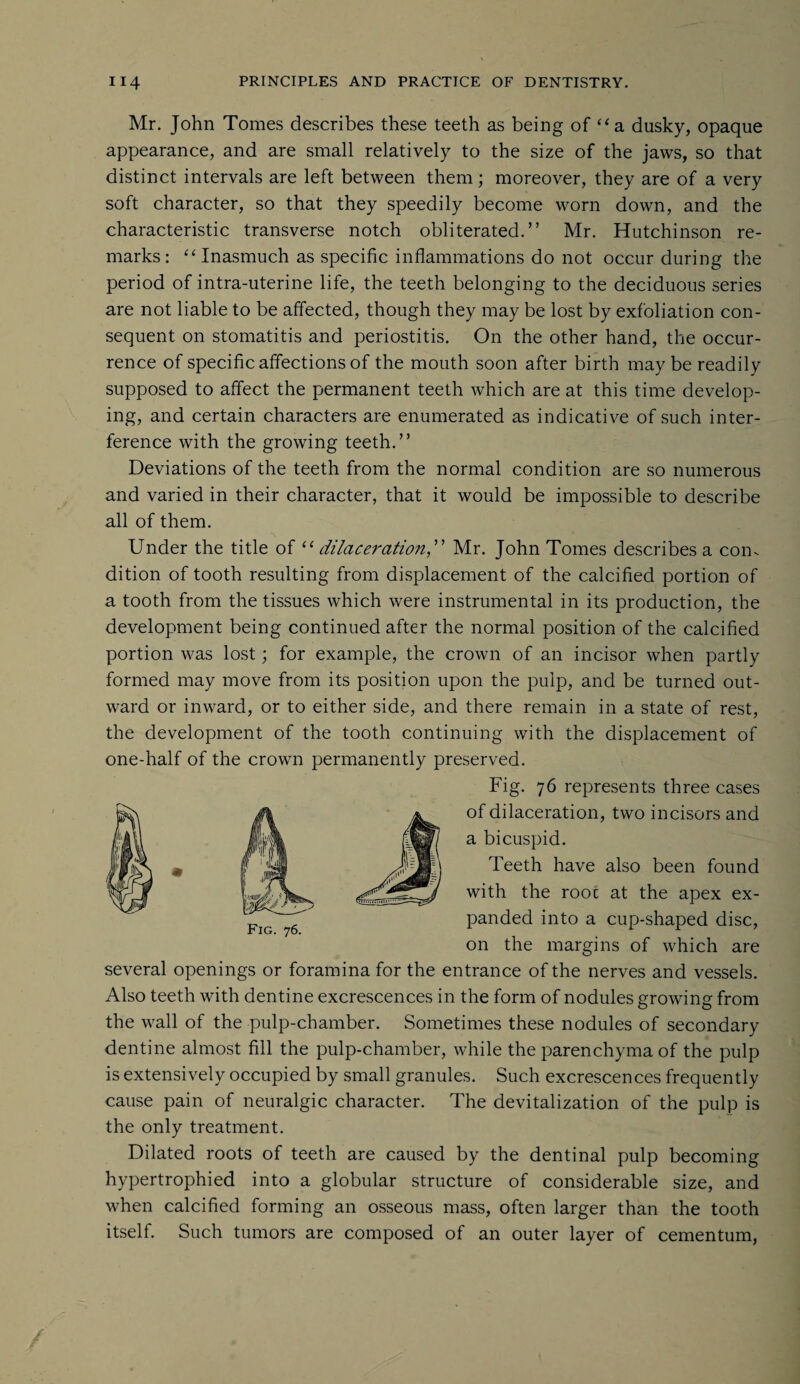 Mr. John Tomes describes these teeth as being of “a dusky, opaque appearance, and are small relatively to the size of the jaws, so that distinct intervals are left between them; moreover, they are of a very soft character, so that they speedily become worn down, and the characteristic transverse notch obliterated.” Mr. Hutchinson re¬ marks: “Inasmuch as specific inflammations do not occur during the period of intra-uterine life, the teeth belonging to the deciduous series are not liable to be affected, though they may be lost by exfoliation con¬ sequent on stomatitis and periostitis. On the other hand, the occur¬ rence of specific affections of the mouth soon after birth maybe readily supposed to affect the permanent teeth which are at this time develop¬ ing, and certain characters are enumerated as indicative of such inter¬ ference with the growing teeth.” Deviations of the teeth from the normal condition are so numerous and varied in their character, that it would be impossible to describe all of them. Under the title of “ dilaceration,” Mr. John Tomes describes a con¬ dition of tooth resulting from displacement of the calcified portion of a tooth from the tissues which were instrumental in its production, the development being continued after the normal position of the calcified portion was lost; for example, the crown of an incisor when partly formed may move from its position upon the pulp, and be turned out¬ ward or inward, or to either side, and there remain in a state of rest, the development of the tooth continuing with the displacement of one-half of the crown permanently preserved. Fig. 76 represents three cases of dilaceration, two incisors and a bicuspid. Teeth have also been found with the root at the apex ex¬ panded into a cup-shaped disc, on the margins of which are Fig. 76. several openings or foramina for the entrance of the nerves and vessels. Also teeth with dentine excrescences in the form of nodules growing from the wall of the pulp-chamber. Sometimes these nodules of secondary dentine almost fill the pulp-chamber, while the parenchyma of the pulp is extensively occupied by small granules. Such excrescences frequently cause pain of neuralgic character. The devitalization of the pulp is the only treatment. Dilated roots of teeth are caused by the dentinal pulp becoming hypertrophied into a globular structure of considerable size, and when calcified forming an osseous mass, often larger than the tooth itself. Such tumors are composed of an outer layer of cementum,