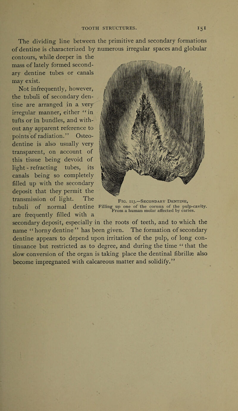 The dividing line between the primitive and secondary formations of dentine is characterized by numerous irregular spaces and globular contours, while deeper in the mass of lately formed second¬ ary dentine tubes or canals may exist. Not infrequently, however, the tubuli of secondary den¬ tine are arranged in a very irregular manner, either “in tufts or in bundles, and with¬ out any apparent reference to points of radiation. ’ ’ Osteo- dentine is also usually very transparent, on account of this tissue being devoid of light - refracting tubes, its canals being so completely filled up with the secondary deposit that they permit the transmission of light. The tubuli of normal are frequently filled with a secondary deposit, especially in the roots of teeth, and to which the name “ horny dentine ” has been given. The formation of secondary dentine appears to depend upon irritation of the pulp, of long con¬ tinuance but restricted as to degree, and during the time “that the slow conversion of the organ is taking place the dentinal fibrillse also become impregnated with calcareous matter and solidify. Fig. i 13.—Secondary Dentine, dentine Filling- up one of the cornua of the pulp-cavity. From a human molar affected by caries. > >