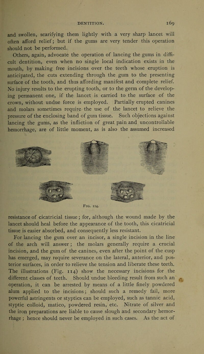 and swollen, scarifying them lightly with a very sharp lancet will often afford relief; but if the gums are very tender this operation should not be performed. Others, again, advocate the operation of lancing the gums in diffi¬ cult dentition, even when no single local indication exists in the mouth, by making free incisions over the teeth whose eruption is anticipated, the cuts extending through the gum to the presenting surface of the tooth, and thus affording manifest and complete relief. No injury results to the erupting tooth, or to the germ of the develop¬ ing permanent one, if the lancet is carried to the surface of the crown, without undue force is employed. Partially erupted canines and molars sometimes require the use of the lancet to relieve the pressure of the enclosing band of gum tissue. Such objections against lancing the gums, as the infliction of great pain and uncontrollable hemorrhage, are of little moment, as is also the assumed increased Fig. 114. resistance of cicatricial tissue; for, although the wound made by the lancet should heal before the appearance of the tooth, this cicatricial tissue is easier absorbed, and consequently less resistant. For lancing the gum over an incisor, a single incision in the line of the arch will answer; the molars generally require a crucial incision, and the gum of the canines, even after the point of the cusp has emerged, may require severance on the lateral, anterior, and pos¬ terior surfaces, in order to relieve the tension and liberate these teeth. The illustrations (Fig. 114) show the necessary incisions for the different classes of teeth. Should undue bleeding result from such an operation, it can be arrested by means of a little finely powdered alum applied to the incisions; should such a remedy fail, more powerful astringents or styptics can be employed, such as tannic acid, styptic colloid, matico, powdered resin, etc. Nitrate of silver and the iron preparations are liable to cause slough and secondary hemor¬ rhage ; hence should never be employed in such cases. As the act of