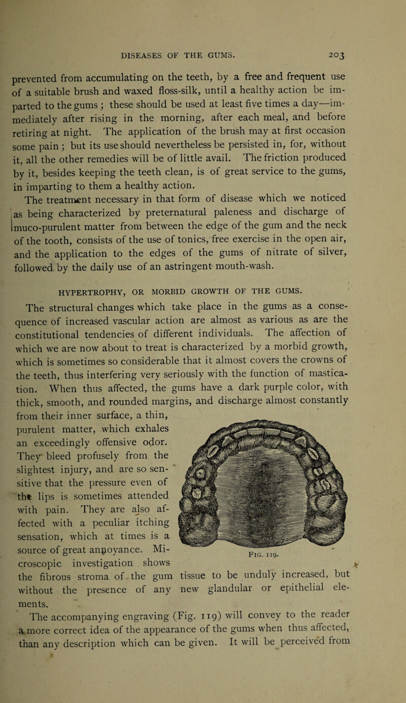 prevented from accumulating on the teeth, by a free and frequent use of a suitable brush and waxed floss-silk, until a healthy action be im¬ parted to the gums ; these should be used at least five times a day—im¬ mediately after rising in the morning, after each meal, and before retiring at night. The application of the brush may at first occasion some pain; but its use should nevertheless be persisted in, for, without it, all the other remedies will be of little avail. The friction produced by it, besides keeping the teeth clean, is of great service to the gums, in imparting to them a healthy action. The treatment necessary in that form of disease which we noticed as being characterized by preternatural paleness and discharge of Imuco-purulent matter from between the edge of the gum and the neck of the tooth, consists of the use of tonics, free exercise in the open air, and the application to the edges of the gums of nitrate of silver, followed by the daily use of an astringent mouth-wash. HYPERTROPHY, OR MORBID GROWTH OF THE GUMS. The structural changes which take place in the gums as a conse¬ quence of increased vascular action are almost as various as are the constitutional tendencies of different individuals. The affection of which we are now about to treat is characterized by a morbid growth, which is sometimes so considerable that it almost covers the crowns of the teeth, thus interfering very seriously with the function of mastica¬ tion. When thus affected, the gums have a dark purple color, with thick, smooth, and rounded margins, and discharge almost constantly from their inner surface, a thin, purulent matter, which exhales an exceedingly offensive odor. They bleed profusely from the slightest injury, and are so sen¬ sitive that the pressure even of thfe lips is sometimes attended with pain. They are ajso af¬ fected with a peculiar itching sensation, which at times is a source of great annoyance. Mi¬ croscopic investigation shows the fibrous stroma of the gum tissue to be unduly increased, but without the presence of any new glandular or epithelial ele¬ ments. The accompanying engraving (Fig. 119) will convey to the reader a more correct idea of the appearance of the gums when thus affected, than any description which can be given. It will be perceived from