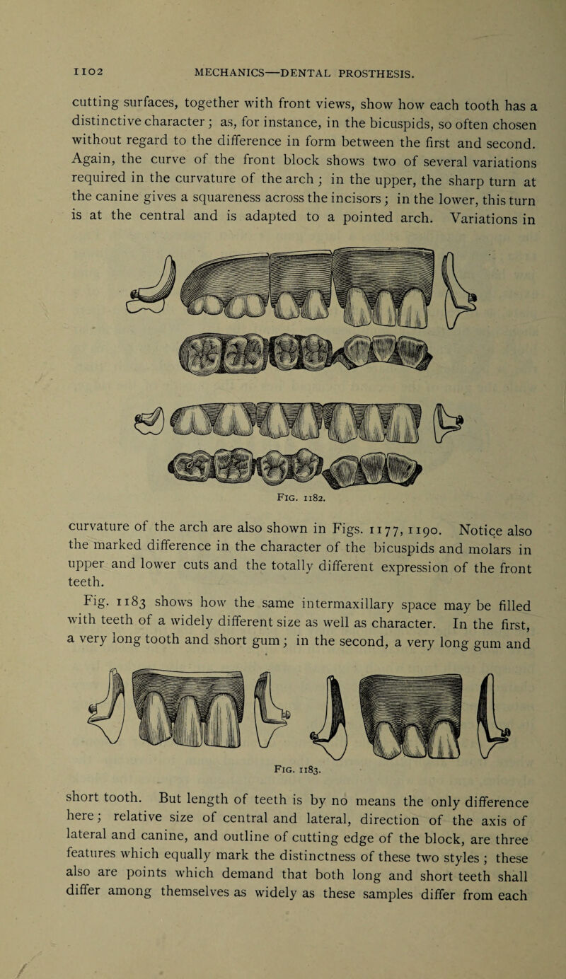 cutting surfaces, together with front views, show how each tooth has a distinctive character ; as, for instance, in the bicuspids, so often chosen without regard to the difference in form between the first and second. Again, the curve of the front block shows two of several variations required in the curvature of the arch ; in the upper, the sharp turn at the canine gives a squareness across the incisors; in the lower, this turn is at the cential and is adapted to a pointed arch. Variations in Fig. 1182. curvature ot the arch are also shown in Figs. 1177, iipo. Notice also the marked difference in the character of the bicuspids and molars in upper and lower cuts and the totally different expression of the front teeth. Fig. 1183 shows how the same intermaxillary space maybe filled with teeth of a widely different size as well as character. In the first, a very long tooth and short gum; in the second, a very long gum and Fig. 1183. short tooth. But length of teeth is by no means the only difference heie, relative size of central and lateral, direction of the axis of lateral and canine, and outline of cutting edge of the block, are three features which equally mark the distinctness of these two styles ; these also are points which demand that both long and short teeth shall differ among themselves as widely as these samples differ from each