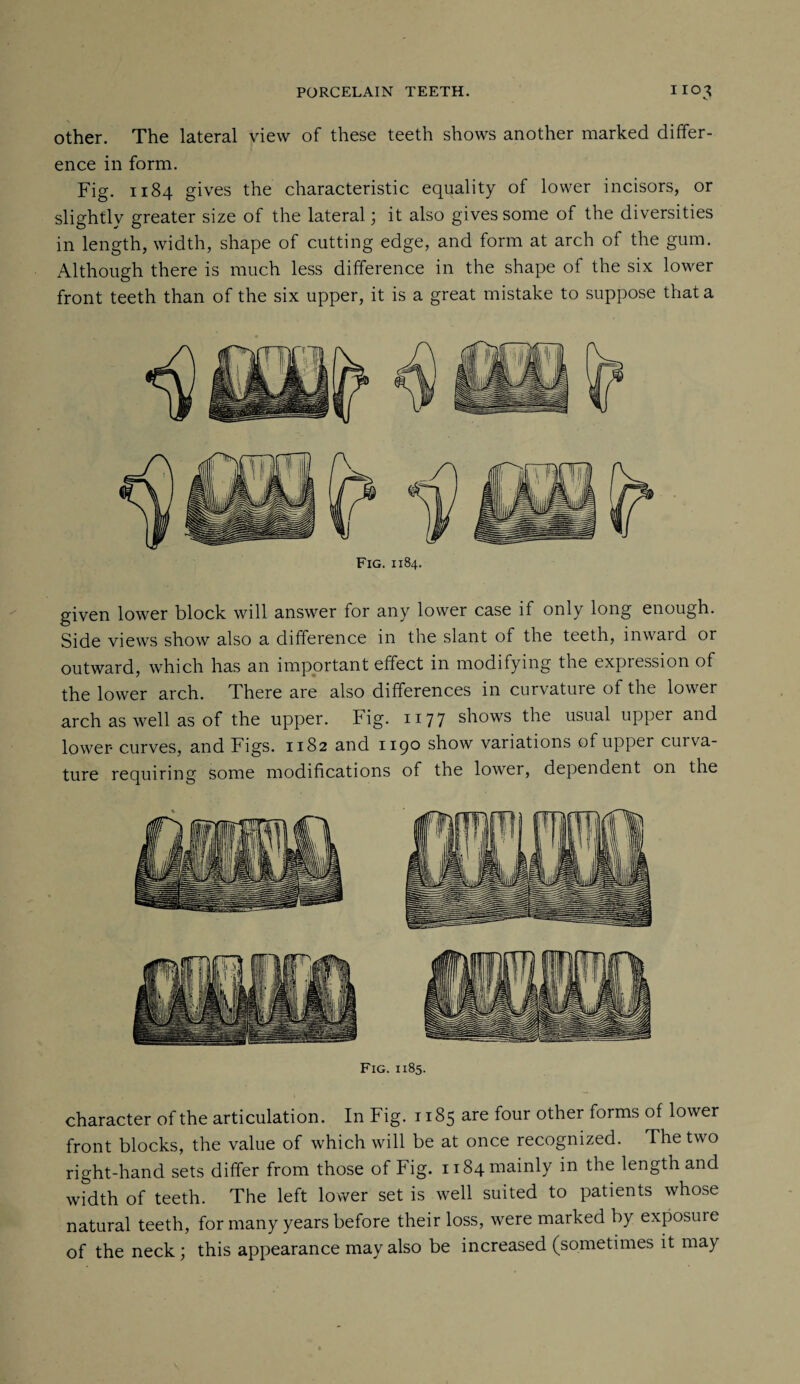 VT other. The lateral view of these teeth shows another marked differ¬ ence in form. Fig. 1184 gives the characteristic equality of lower incisors, or slightly greater size of the lateral; it also gives some of the diversities in length, width, shape of cutting edge, and form at arch of the gum. Although there is much less difference in the shape of the six lower front teeth than of the six upper, it is a great mistake to suppose that a Fig. 1184. given lower block will answer for any lower case if only long enough. Side views show also a difference in the slant of the teeth, inward or outward, which has an important effect in modifying the expression of the lower arch. There are also differences in curvature of the lower arch as well as of the upper. Fig. 1177 shows the usual upper and lower curves, and Figs. 1182 and 119° show variations of upper cuiva- ture requiring some modifications of the lower, dependent on the Fig. 1185. character of the articulation. In Fig. 1185 are four other forms of lower front blocks, the value of which will be at once recognized. The two right-hand sets differ from those of Fig. 1184 mainly in the length and width of teeth. The left lower set is well suited to patients whose natural teeth, for many years before their loss, were marked by exposure of the neck; this appearance may also be increased (sometimes it may