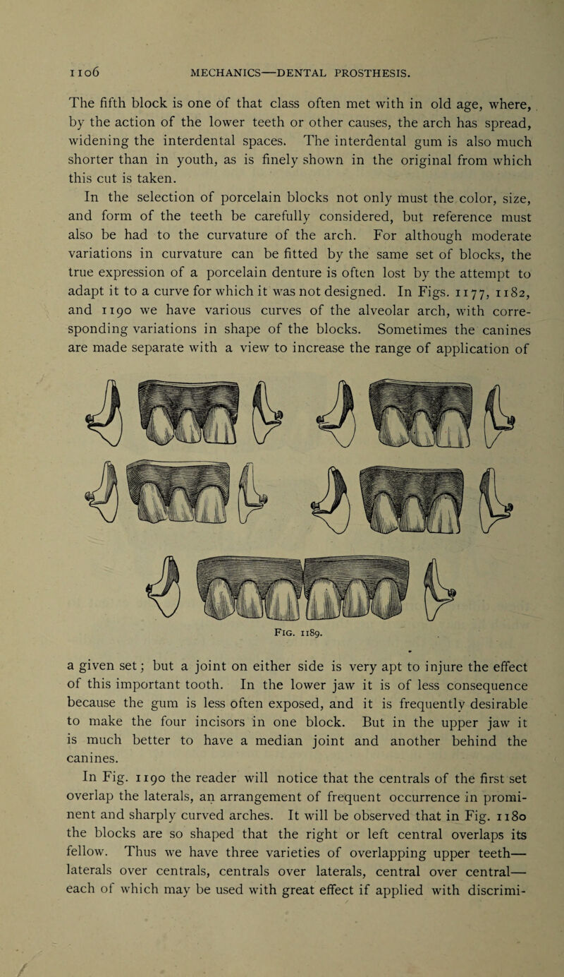 The fifth block is one of that class often met with in old age, where, by the action of the lower teeth or other causes, the arch has spread, widening the interdental spaces. The interdental gum is also much shorter than in youth, as is finely shown in the original from which this cut is taken. In the selection of porcelain blocks not only must the color, size, and form of the teeth be carefully considered, but reference must also be had to the curvature of the arch. For although moderate variations in curvature can be fitted by the same set of blocks, the true expression of a porcelain denture is often lost by the attempt to adapt it to a curve for which it was not designed. In Figs. 1177, 1182, and 1190 we have various curves of the alveolar arch, with corre¬ sponding variations in shape of the blocks. Sometimes the canines are made separate with a view to increase the range of application of Fig. 1189. a given set; but a joint on either side is very apt to injure the effect of this important tooth. In the lower jaw it is of less consequence because the gum is less often exposed, and it is frequently desirable to make the four incisors in one block. But in the upper jaw it is much better to have a median joint and another behind the canines. In Fig. 1190 the reader will notice that the centrals of the first set overlap the laterals, an arrangement of frequent occurrence in promi¬ nent and sharply curved arches. It will be observed that in Fig. 1180 the blocks are so shaped that the right or left central overlaps its fellow. Thus we have three varieties of overlapping upper teeth— laterals over centrals, centrals over laterals, central over central— each ol which may be used with great effect if applied with discrimi-