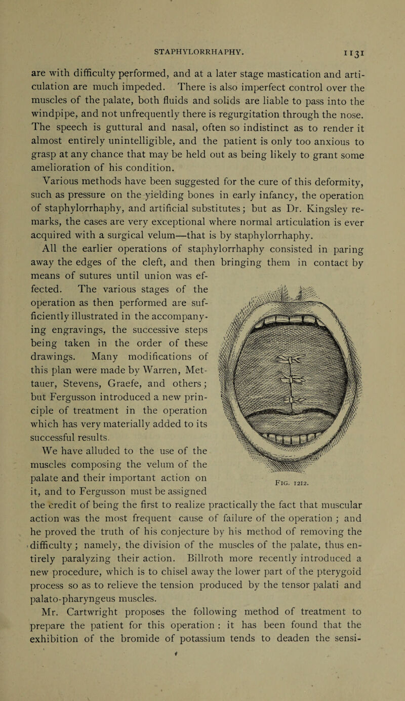 H31 are with difficulty performed, and at a later stage mastication and arti¬ culation are much impeded. There is also imperfect control over the muscles of the palate, both fluids and solids are liable to pass into the windpipe, and not unfrequently there is regurgitation through the nose. The speech is guttural and nasal, often so indistinct as to render it almost entirely unintelligible, and the patient is only too anxious to grasp at any chance that may be held out as being likely to grant some amelioration of his condition. Various methods have been suggested for the cure of this deformity, such as pressure on the yielding bones in early infancy, the operation of staphylorrhaphy, and artificial substitutes; but as Dr. Kingsley re¬ marks, the cases are very exceptional where normal articulation is ever acquired with a surgical velum—that is by staphylorrhaphy. All the earlier operations of staphylorrhaphy consisted in paring away the edges of the cleft, and then bringing them in contact by means of sutures until union was ef¬ fected. The various stages of the operation as then performed are suf¬ ficiently illustrated in the accompany¬ ing engravings, the successive steps being taken in the order of these drawings. Many modifications of this plan were made by Warren, Met- tauer, Stevens, Graefe, and others; but Fergusson introduced a new prin¬ ciple of treatment in the operation which has very materially added to its successful results. We have alluded to the use of the muscles composing the velum of the palate and their important action on it, and to Fergusson must be assigned the credit of being the first to realize practically the fact that muscular action was the most frequent cause of failure of the operation ; and he proved the truth of his conjecture by his method of removing the difficulty; namely, the division of the muscles of the palate, thus en¬ tirely paralyzing their action. Billroth more recently introduced a new procedure, which is to chisel away the lower part of the pterygoid process so as to relieve the tension produced by the tensor palati and palato-pharyngeus muscles. Mr. Cartwright proposes the following method of treatment to prepare the patient for this operation : it has been found that the exhibition of the bromide of potassium tends to deaden the sensi-