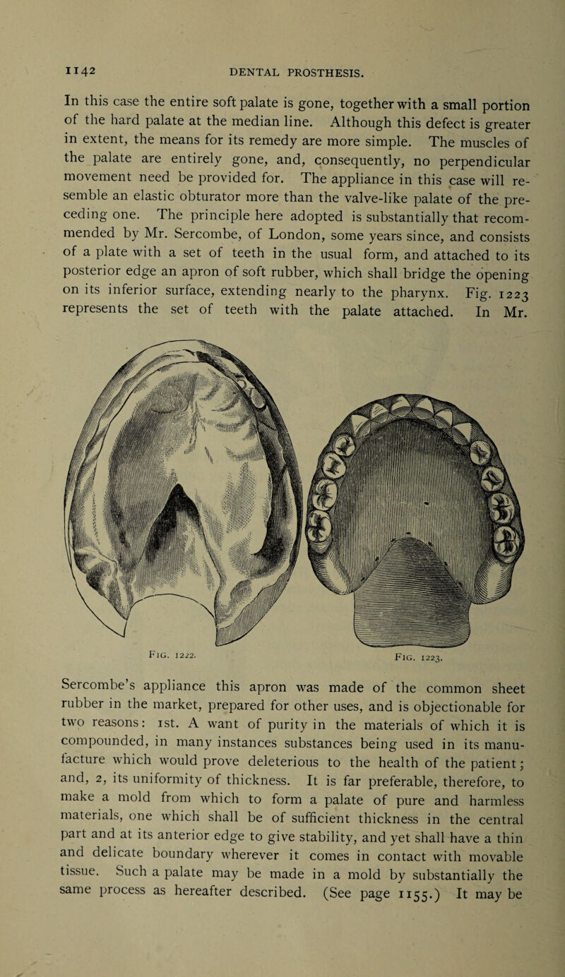 In this case the entire soft palate is gone, together with a small portion of the hard palate at the median line. Although this defect is greater in extent, the means for its remedy are more simple. The muscles of the palate are entirely gone, and, consequently, no perpendicular movement need be provided for. The appliance in this case will re¬ semble an elastic obturator more than the valve-like palate of the pre¬ ceding one. The principle here adopted is substantially that recom¬ mended by Mr. Sercombe, of London, some years since, and consists of a plate with a set of teeth in the usual form, and attached to its posterior edge an apron of soft rubber, which shall bridge the opening on its inferior surface, extending nearly to the pharynx. Fig. 1223 represents the set of teeth with the palate attached. In Mr. FjG. 1222. Fig. 1223. Sercombe s appliance this apron was made of the common sheet rubber in the market, prepared for other uses, and is objectionable for two reasons: 1st. A want of purity in the materials of which it is compounded, in many instances substances being used in its manu- lactuie which would prove deleterious to the health of the patient; and, 2, its uniformity of thickness. It is far preferable, therefore, to make a mold from which to form a palate of pure and harmless materials, one which shall be of sufficient thickness in the central part and at its anterior edge to give stability, and yet shall have a thin and delicate boundary wherever it comes in contact with movable tissue. Such a palate may be made in a mold by substantially the same process as hereafter described. (See page 1155.) It maybe