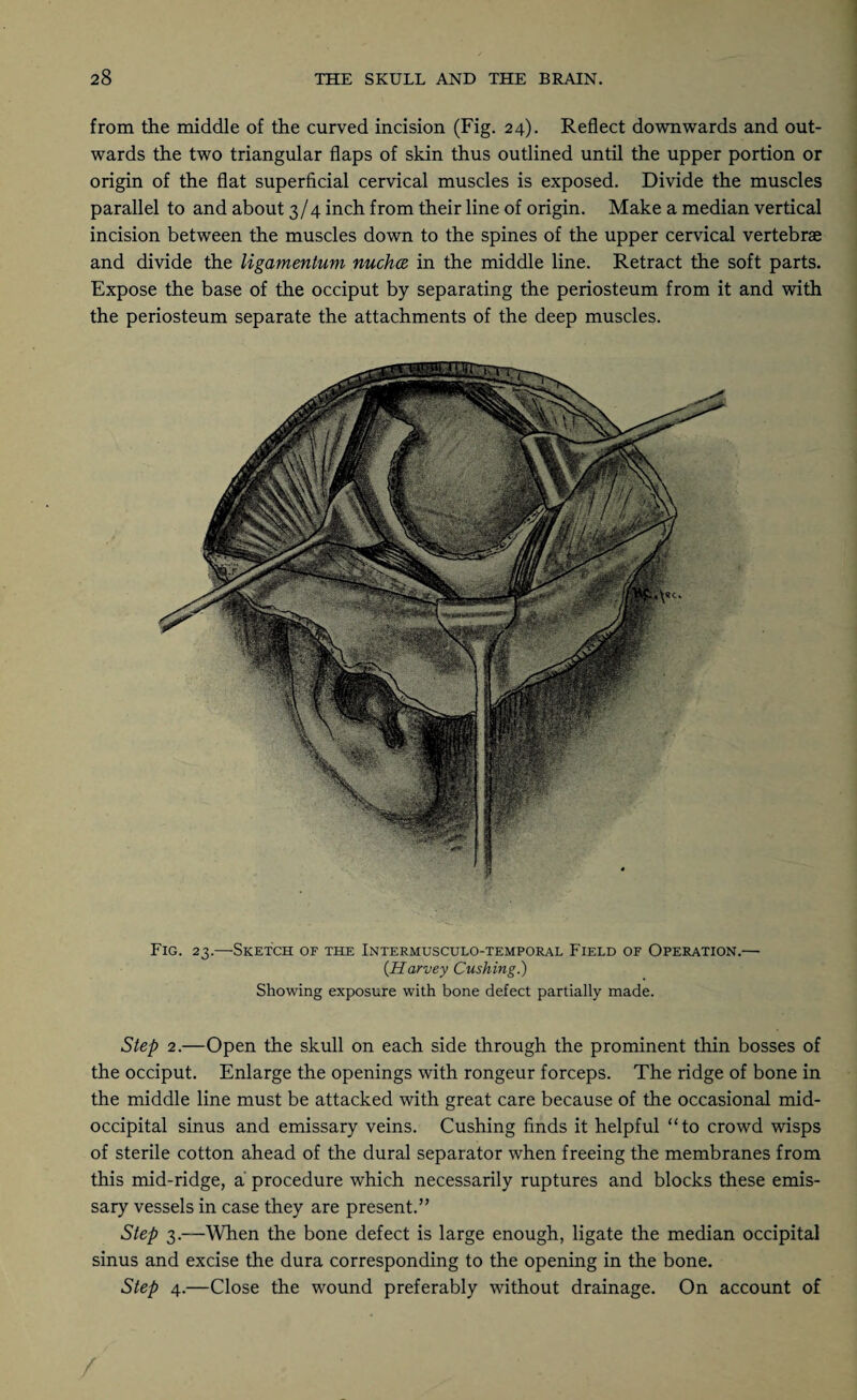 from the middle of the curved incision (Fig. 24). Reflect downwards and out¬ wards the two triangular flaps of skin thus outlined until the upper portion or origin of the flat superficial cervical muscles is exposed. Divide the muscles parallel to and about 3/4 inch from their line of origin. Make a median vertical incision between the muscles down to the spines of the upper cervical vertebrae and divide the ligamentum nucha in the middle line. Retract the soft parts. Expose the base of the occiput by separating the periosteum from it and with the periosteum separate the attachments of the deep muscles. Fig. 23.—Sketch of the Intermusculo-temporal Field of Operation.— {Harvey Cushing.) Showing exposure with bone defect partially made. Step 2.—Open the skull on each side through the prominent thin bosses of the occiput. Enlarge the openings with rongeur forceps. The ridge of bone in the middle line must be attacked with great care because of the occasional mid- occipital sinus and emissary veins. Cushing finds it helpful “to crowd wisps of sterile cotton ahead of the dural separator when freeing the membranes from this mid-ridge, a procedure which necessarily ruptures and blocks these emis¬ sary vessels in case they are present.” Step 3.—When the bone defect is large enough, ligate the median occipital sinus and excise the dura corresponding to the opening in the bone. Step 4.—Close the wound preferably without drainage. On account of