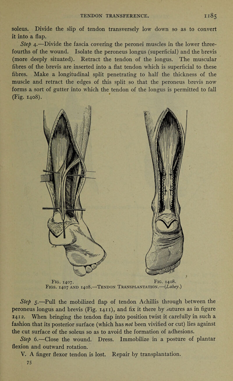 soleus. Divide the slip of tendon transversely low down so as to convert it into a flap. Step 4.—Divide the fascia covering the peronei muscles in the lower three- fourths of the wound. Isolate the peroneus longus (superficial) and the brevis (more deeply situated). Retract the tendon of the longus. The muscular fibres of the brevis are inserted into a flat tendon which is superficial to these fibres. Make a longitudinal split penetrating to half the thickness of the muscle and retract the edges of this split so that the peroneus brevis now forms a sort of gutter into which the tendon of the longus is permitted to fall (Fig. 1408). Fig. 1407. Fig. 1408. Figs. 1407 and 1408.—Tendon Transplantation.—(Labey.) Step 5.—Pull the mobilized flap of tendon Achillis through between the peroneus longus and brevis (Fig. 1411), and fix it there by sutures as in figure 1412. When bringing the tendon flap into position twist it carefully in such a fashion that its posterior surface (which has not been vivified or cut) lies against the cut surface of the soleus so as to avoid the formation of adhesions. Step 6.—Close the wound. Dress. Immobilize in a posture of plantar flexion and outward rotation. V. A finger flexor tendon is lost. Repair by transplantation. 75