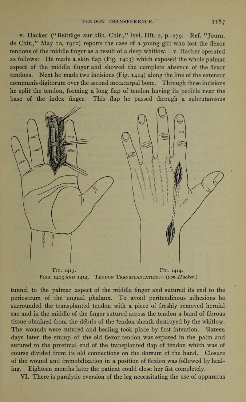 v. Hacker (“Beitrage zur klin. Chir.,” lxvi, Hft. 2, p. 279. Ref. “Journ. de Chir./’ May 10, 1910) reports the case of a young girl who lost the flexor tendons of the middle finger as a result of a deep whitlow, v. Hacker operated as follows: He made a skin flap (Fig. 1413) which exposed the whole palmar aspect of the middle finger and showed the complete absence of the flexor tendons. Next he made two incisions (Fig. 1414) along the line of the extensor communis digitorum over the second metacarpal bone. Through these incisions he split the tendon, forming a long flap of tendon having its pedicle near the base of the index finger. This flap he passed through a subcutaneous Fig. 1414. Figs. 1413 and 1414.—Tendon Transplantation.—(von Hacker.) tunnel to the palmar aspect of the middle finger and sutured its end to the periosteum of the ungual phalanx. To avoid peritendinous adhesions he surrounded the transplanted tendon with a piece of freshly removed hernial sac and in the middle of the finger sutured across the tendon a band of fibrous tissue obtained from the debris of the tendon sheath destroyed by the whitlow. The wounds were sutured and healing took place by first intention. Sixteen days later the stump of the old flexor tendon was exposed in the palm and sutured to the proximal end of the transplanted flap of tendon which was of course divided from its old connections on the dorsum of the hand. Closure of the wound and immobilization in a position of flexion was followed by heal¬ ing. Eighteen months later the patient could close her fist completely. VI. There is paralytic eversion of the leg necessitating the use of apparatus