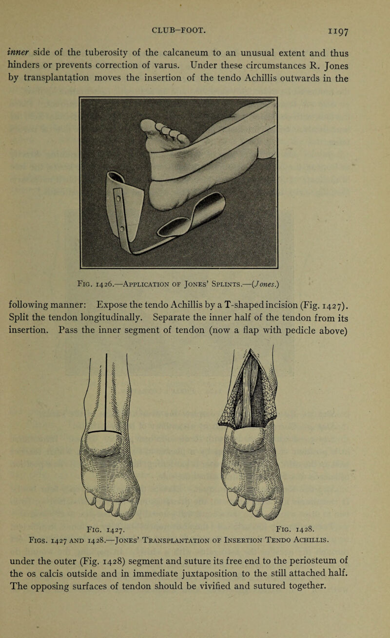 inner side of the tuberosity of the calcaneum to an unusual extent and thus hinders or prevents correction of varus. Under these circumstances R. Jones by transplantation moves the insertion of the tendo Achillis outwards in the Fig. 1426.—Application of Jones’ Splints.—{Jones.) following manner: Expose the tendo Achillis by a T-shaped incision (Fig. 1427). Split the tendon longitudinally. Separate the inner half of the tendon from its insertion. Pass the inner segment of tendon (now a flap with pedicle above) Fig. 1427. Figs. 1427 and 1428.—Jones’ Fig. 1428. Transplantation of Insertion Tendo Achillis. under the outer (Fig. 1428) segment and suture its free end to the periosteum of the os calcis outside and in immediate juxtaposition to the still attached half. The opposing surfaces of tendon should be vivified and sutured together.