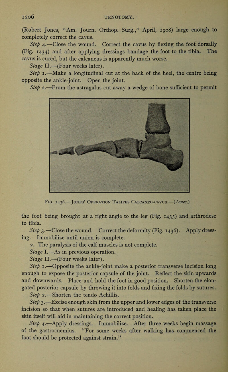 (Robert Jones, “Am. Journ. Orthop. Surg.,” April, 1908) large enough to completely correct the cavus. Step 4.—Close the wound. Correct the cavus by flexing the foot dorsally (Fig. 1434) and after applying dressings bandage the foot to the tibia. The cavus is cured, but the calcaneus is apparently much worse. Stage II.—(Four weeks later). Step 1.—Make a longitudinal cut at the back of the heel, the centre being opposite the ankle-joint. Open the joint. Step 2.—From the astragalus cut away a wedge of bone sufficient to permit Fig. 1436.—Jones’ Operation Talipes Calcaneo-cavus.—{Jones.) the foot being brought at a right angle to the leg (Fig. 1435) and arthrodese to tibia. Step 3.—Close the wound. Correct the deformity (Fig. 1436). Apply dress¬ ing. Immobilize until union is complete. 2. The paralysis of the calf muscles is not complete. Stage I.—As in previous operation. Stage II.—(Four weeks later). Step 1.—Opposite the ankle-joint make a posterior transverse incision long enough to expose the posterior capsule of the joint. Reflect the skin upwards and downwards. Place and hold the foot in good position. Shorten the elon¬ gated posterior capsule by throwing it into folds and fixing the folds by sutures. Step 2.—Shorten the tendo Achillis. Step 3.—Excise enough skin from the upper and lower edges of the transverse incision so that when sutures are introduced and healing has taken place the skin itself will aid in maintaining the correct position. Step 4.—Apply dressings. Immobilize. After three weeks begin massage of the gastrocnemius. “For some weeks after walking has commenced the foot should be protected against strain.”