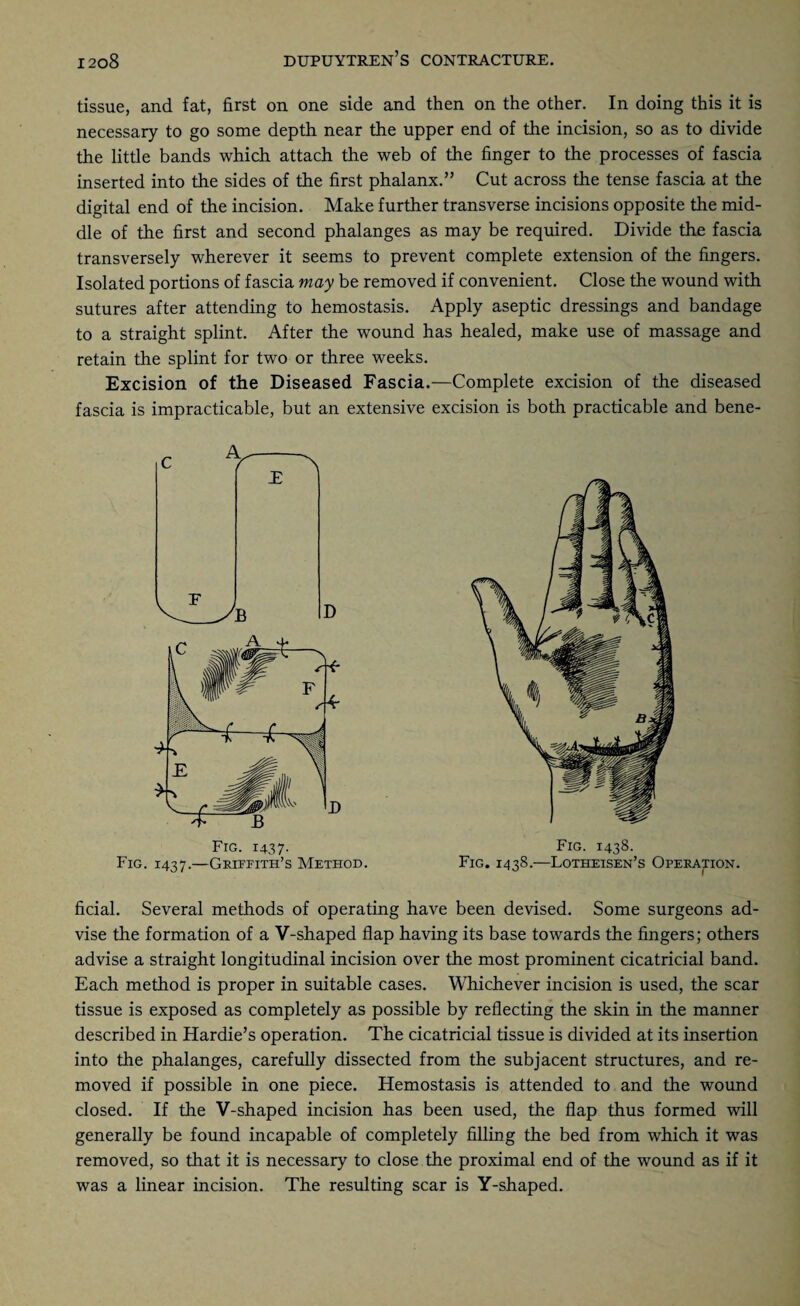 tissue, and fat, first on one side and then on the other. In doing this it is necessary to go some depth near the upper end of the incision, so as to divide the little bands which attach the web of the finger to the processes of fascia inserted into the sides of the first phalanx.” Cut across the tense fascia at the digital end of the incision. Make further transverse incisions opposite the mid¬ dle of the first and second phalanges as may be required. Divide the fascia transversely wherever it seems to prevent complete extension of the fingers. Isolated portions of fascia may be removed if convenient. Close the wound with sutures after attending to hemostasis. Apply aseptic dressings and bandage to a straight splint. After the wound has healed, make use of massage and retain the splint for two or three weeks. Excision of the Diseased Fascia.—Complete excision of the diseased fascia is impracticable, but an extensive excision is both practicable and bene- Fig. 1438. Fig. 1438.—Lotheisen’s Operation. ficial. Several methods of operating have been devised. Some surgeons ad¬ vise the formation of a V-shaped flap having its base towards the fingers; others advise a straight longitudinal incision over the most prominent cicatricial band. Each method is proper in suitable cases. Whichever incision is used, the scar tissue is exposed as completely as possible by reflecting the skin in the manner described in Hardie’s operation. The cicatricial tissue is divided at its insertion into the phalanges, carefully dissected from the subjacent structures, and re¬ moved if possible in one piece. Hemostasis is attended to and the wound closed. If the V-shaped incision has been used, the flap thus formed will generally be found incapable of completely filling the bed from which it was removed, so that it is necessary to close the proximal end of the wound as if it was a linear incision. The resulting scar is Y-shaped.